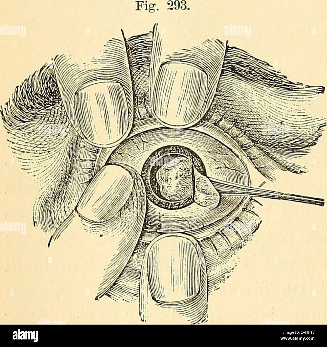 . The principles and practice of surgery. made two linesin length, and then slowly with-drawn, while the aqueous humorescapes. A curved needle is nowintroduced and the capsule cut;when, if the lens does not presentitself spontaneously, slight pressureupon the opposite side of the ball will generally succeed in effecting-itsextrusion. In some cases it will be necessary to facilitate the escape of a pulpycataract, by making the corneal wound more patulous by pressure uponits posterior margin with a Daviels spoon, as represented in the wood-cut. Finally, if these measures fail, the lids must be c Stock Photo