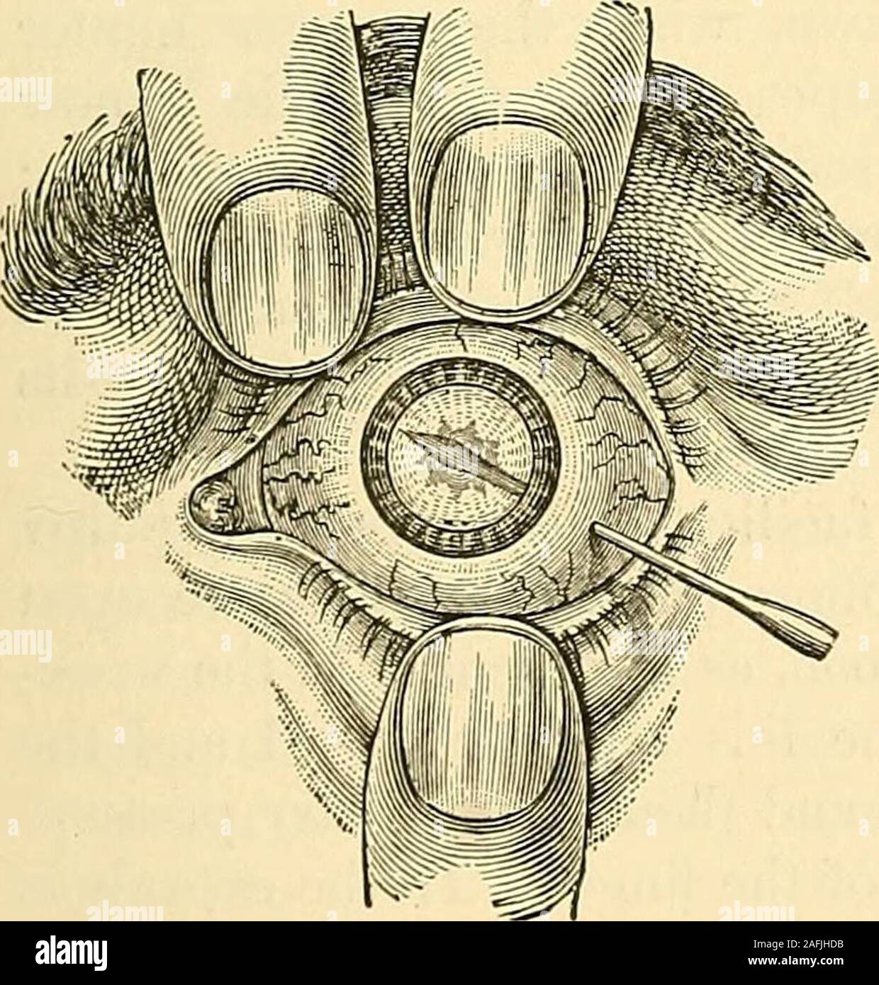 The principles and practice of surgery. ecially suited to cases in which  opaquedeposits upon the capsule may render it necessary to remove it from  theaxis of vision. A spear-shaped needle, after