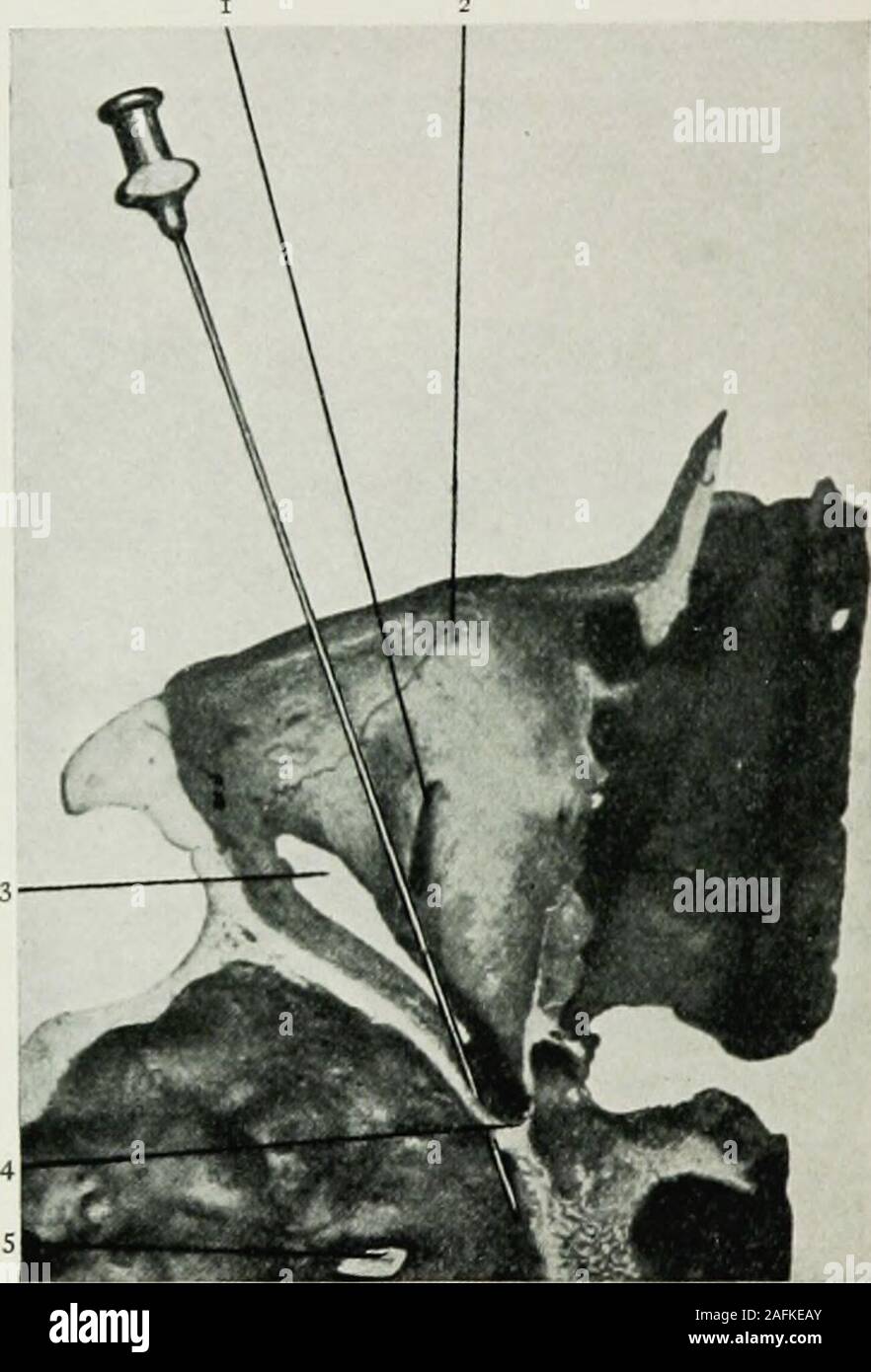 . Local and regional anesthesia : with chapters on spinal, epidural, paravertebral, and parasacral analgesia, and on other applications of local and regional anesthesia to the surgery of the eye, ear, nose and throat, and to dental practice. Fig. 17S.—Needle in position in Matas intra-orbital injection within foramen rotundum. (Braun.) sphenomaxillary fossa, and for a short distance through the spheno-maxillary fissure, and emerge upon the rim of the orbit just internal 5 LOCAL ANESTHESIA to its inferior external angle, at a distance of from 4 to 5 cm., varyingsomewhat in different skulls. It Stock Photo