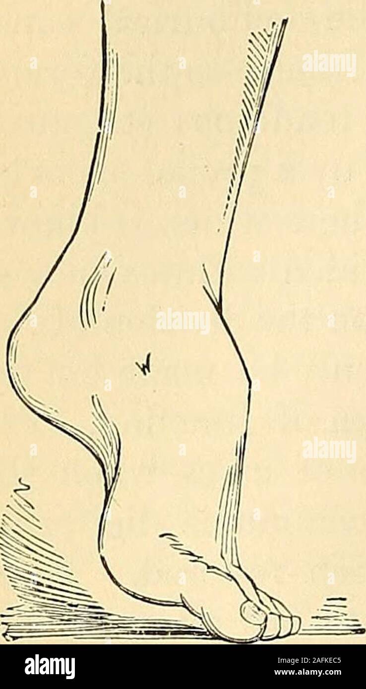 The Principles And Practice Of Surgery Talipes Valgus 4g4 Club Foot Talipes Equinus Cus And Peroneus Tertius Or By Contraction Of The Muscles Which Termi Nate In The Tendo Achillis As In Cases