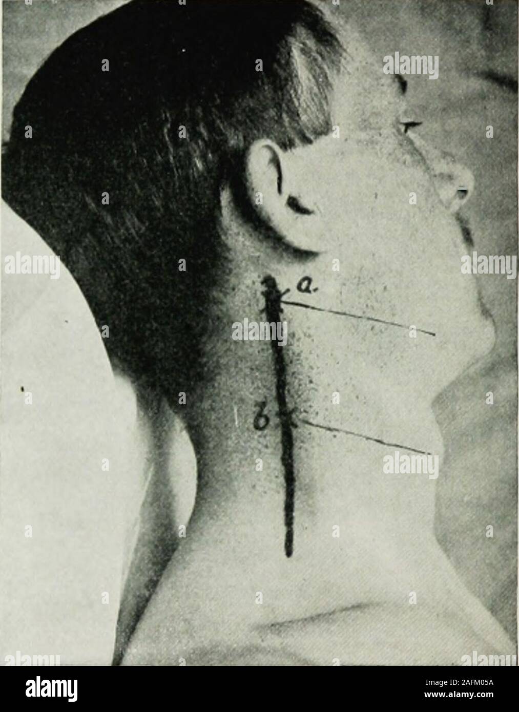 . Local and regional anesthesia : with chapters on spinal, epidural, paravertebral, and parasacral analgesia, and on other applications of local and regional anesthesia to the surgery of the eye, ear, nose and throat, and to dental practice. ebral injections in such regions as the neck mustreceive further experimental study before it can be popularized; thelikelihood of the solution reaching the phrenic nerve in effectivequantity should not be lost sight of; its origin from the third, fourth,and fifth cervical is practically the center of the field, and after forma-tion its course is more supe Stock Photo