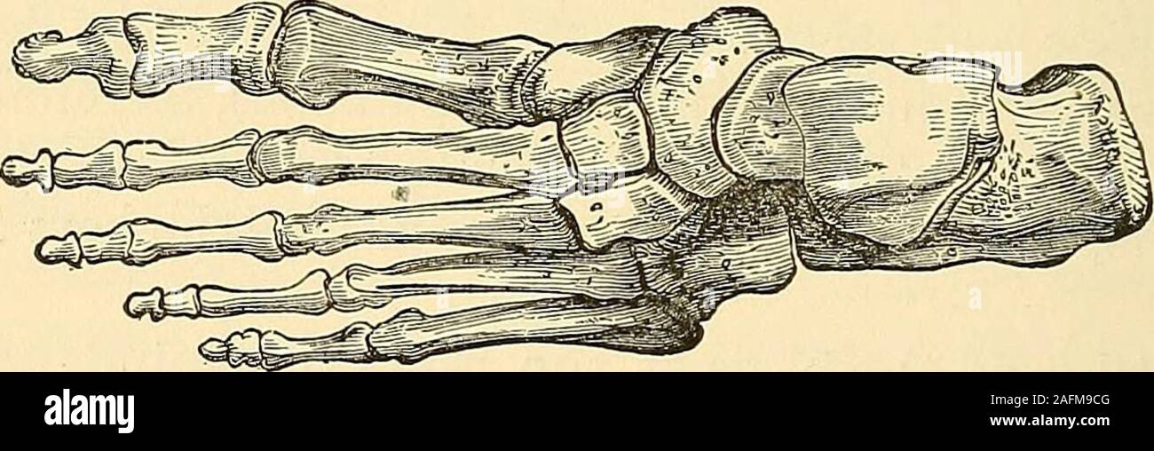 . The principles and practice of surgery. Congenital Hypertrophy of Second Toe. Same after Amputation. tions, nor do they allow the joints to open sufficiently to indicate theirpositions. No one would think of entering these articulations from the plantarsurface, since in this direction they are peculiarly inaccessible, and theprincipal flap must be made from this surface. Fig. 152.. Skeleton of Foot. On the tibial, or inner side, occasionally not much difficulty willbe experienced in finding the point where the metatarsal bone of thegreat toe articulates with the cuneiform, internum. In most Stock Photo