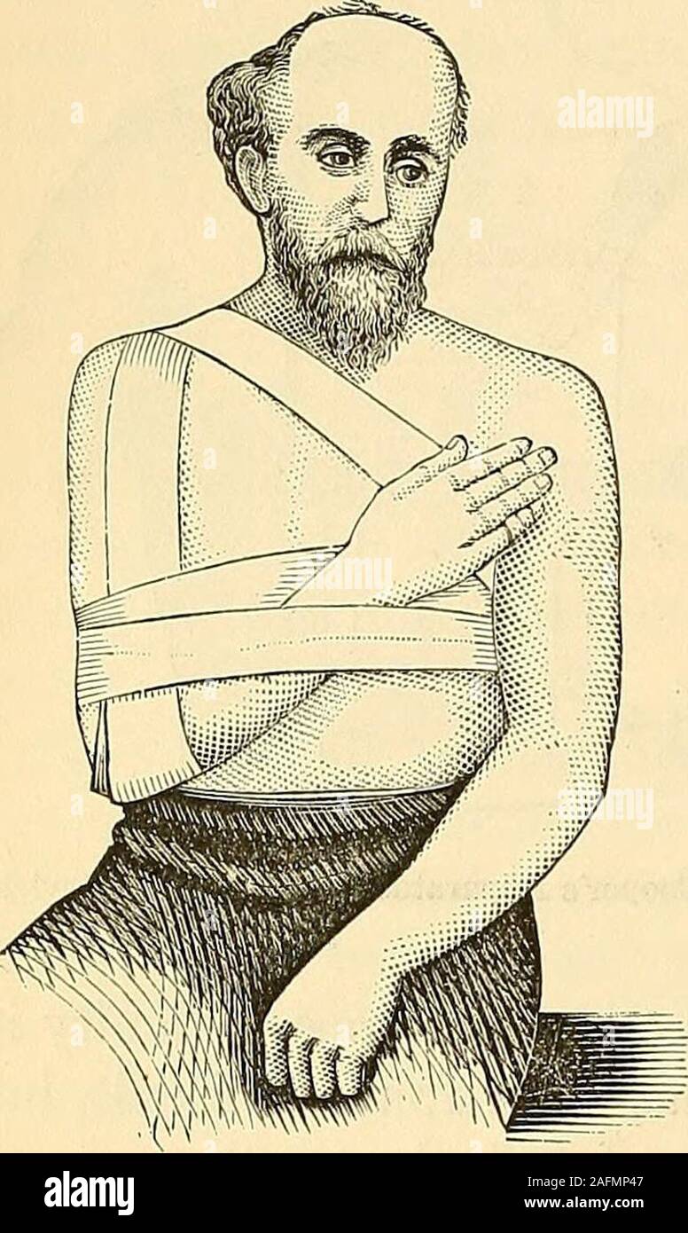 . The principles and practice of surgery. Dislocation of the Acromial End of theClavicle upwards and outwards. 318 DISLOCATIONS OF THE HUMERUS. ^ Petits tourniquet can be employed very conveniently for making thedirect and counter-pressure, as it enables the surgeon to regulate thepressure with ease and accuracy. Fig. 120. Fig. 121.. Stock Photo