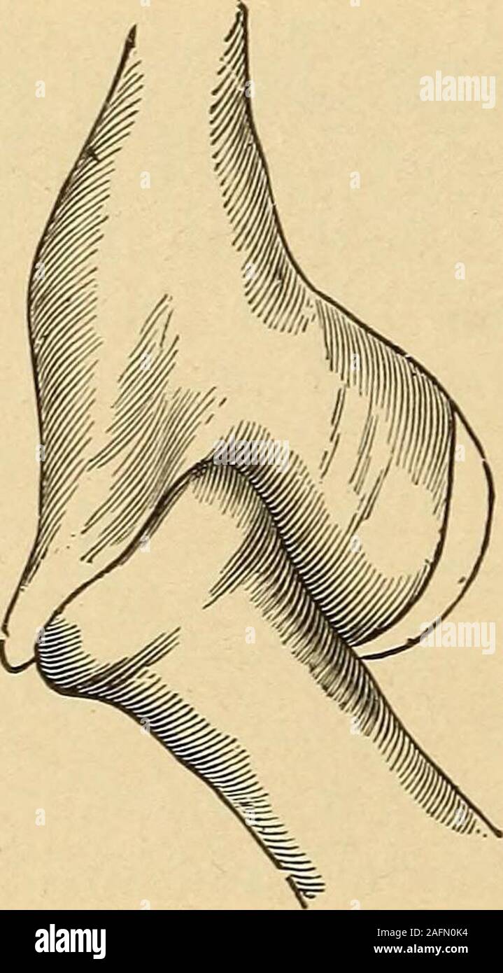 . A practical treatise on fractures and dislocations. 0 DISLOCATIONS. from the radius and the humerus; then, through a longitudinal cutmade in the tendon of the triceps, the adhesions between the olecranonand the back of the humerus were separated, and the bones were theneasily restored to place. The wound healed after slight suppuration,passive motion was begun after the third Aveek, and the patient wasdismissed after seven and a- half weeks with the elbow flexed andmovable through an arc of 35 or 40 degrees. Nine months later hewrote that he could flex and extend the joint freely, but that r Stock Photo