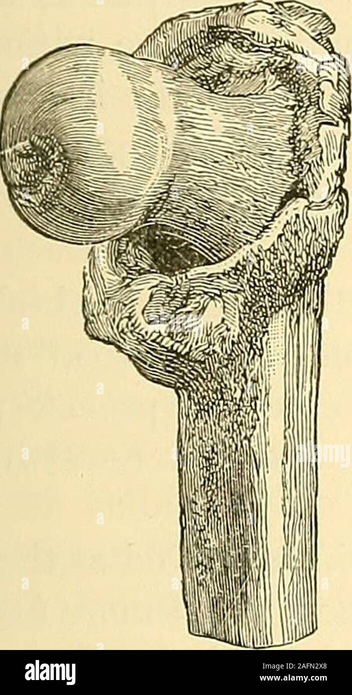 . The principles and practice of surgery. Intra-capsular Fracture united by Ligament. FRACTURES OF THE FEMUR. 289 Prognosis in Extra-eapsular Fractures.—These fractures arealmost invariably impacted ; the neck being driven into the shaft andbase of the trochanter, splitting the trochanter and the upper end of thefemur into several small fragments. The fragments are not, however,completely detached from each other, or even widely separated, owingto the strength of the aponeurotic expansion and tendinous attachmentswhich surround them. Fig. 87. Fig. 88.. Stock Photo