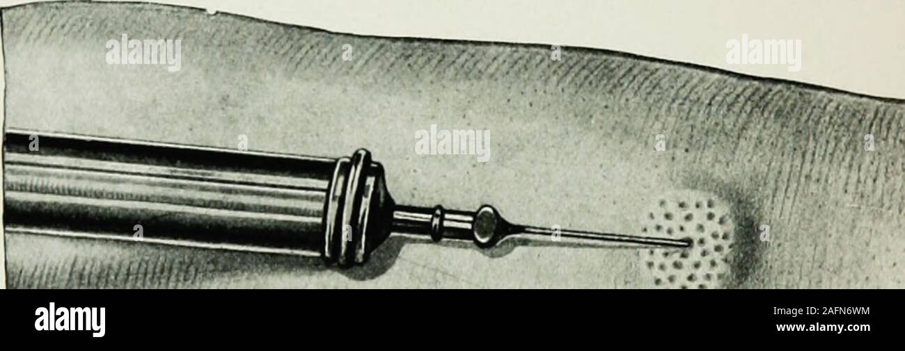 old anesthesia needle