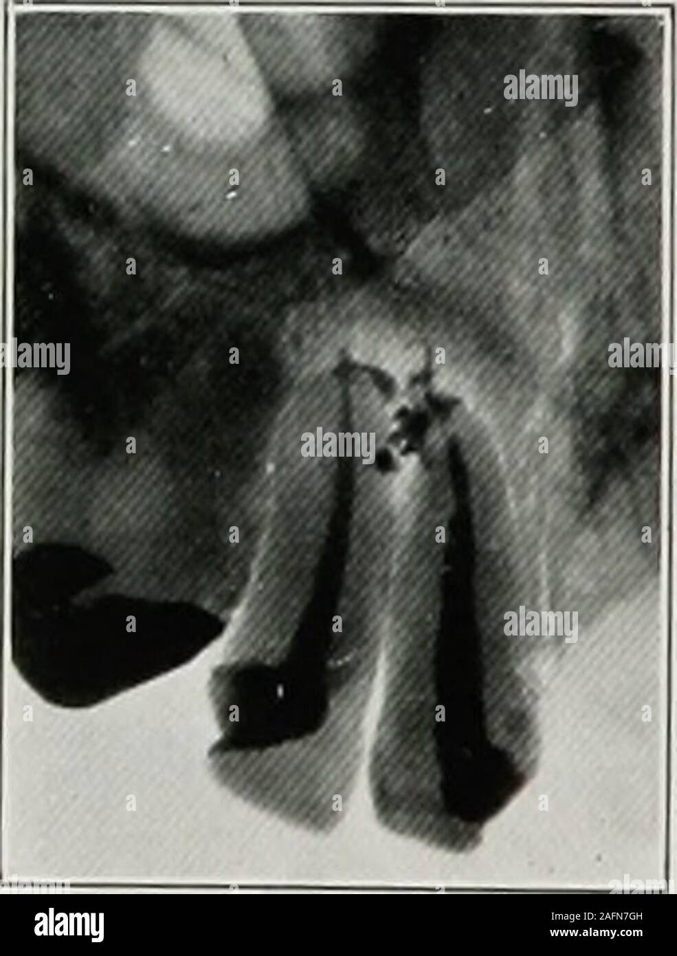 . Dental electro-therapeutics. Fig. 127.—Gutta-percha extendingthrough apex. Fig. 128.—Gutta-percha extend-ing through apex. Taken by J. J.Lowe, Boston. Fig. 129 shows extensive absorption of the end of left uppercanine root. The protruding part of the gutta-percha rootcanal stopping has evidently assumed a nearly horizontalposition. The objection to paraffin as a root-canal filling on accountof the inability to distinguish it on the radiograph has beenmet by the addition of bismuth which makes it show on thefilm, although perhaps not quite as distinctly as gutta-percha, THE USES OF THE X-RAYS Stock Photo