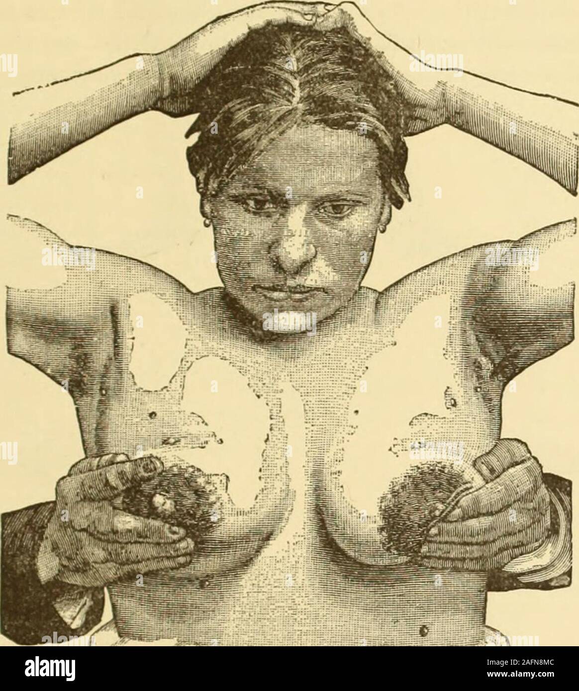 Clinical gyncology, medical and surgical. lia.—In polythelia the  supernumerary nipples follow a linefrom the normal nipple downward and  inward, or upward and outward.This, according to Wiedersheim, would  correspond to the milk-line