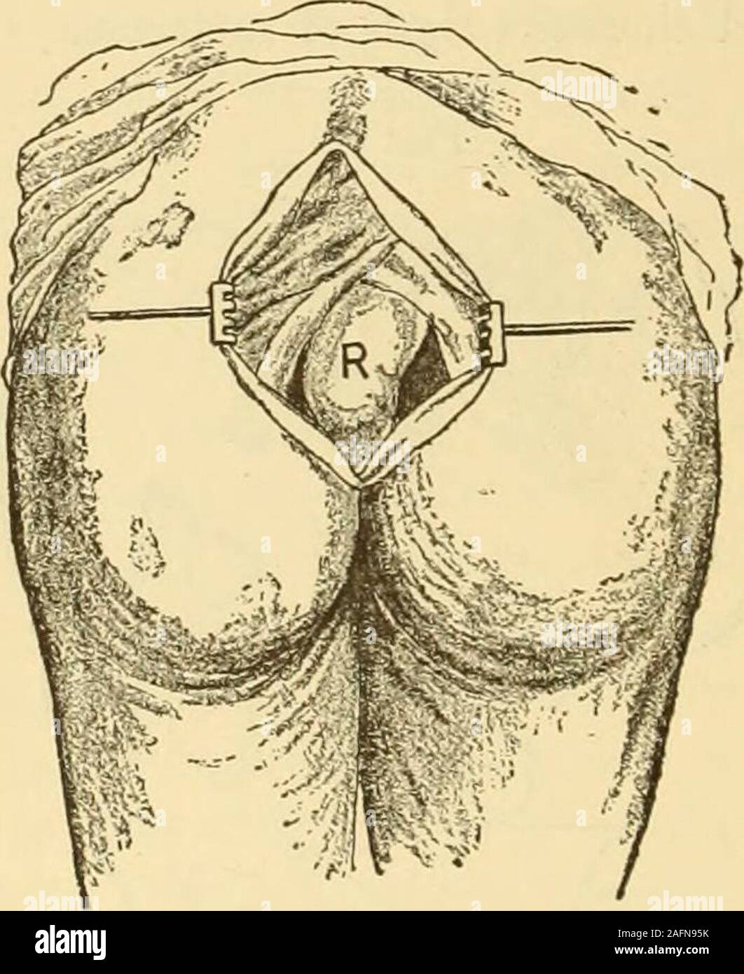 . Clinical gyncology, medical and surgical. reating the obstruction in some cases. This should be made in the left iliacregion in those cases in which the disease involves the greater part of the rec-tum. When it is limited to the anus or the lower five inches of the rectum,extirpation should be performed. This is best done by the sacral method.The patient is placed upon her left side, and a crescentic incision is madeover the sacrum (Fig. 21), beginning at the right side of the sacro-iliac syn-chondrosis, the knife being carried across the median line to the left side,ending to the left of th Stock Photo
