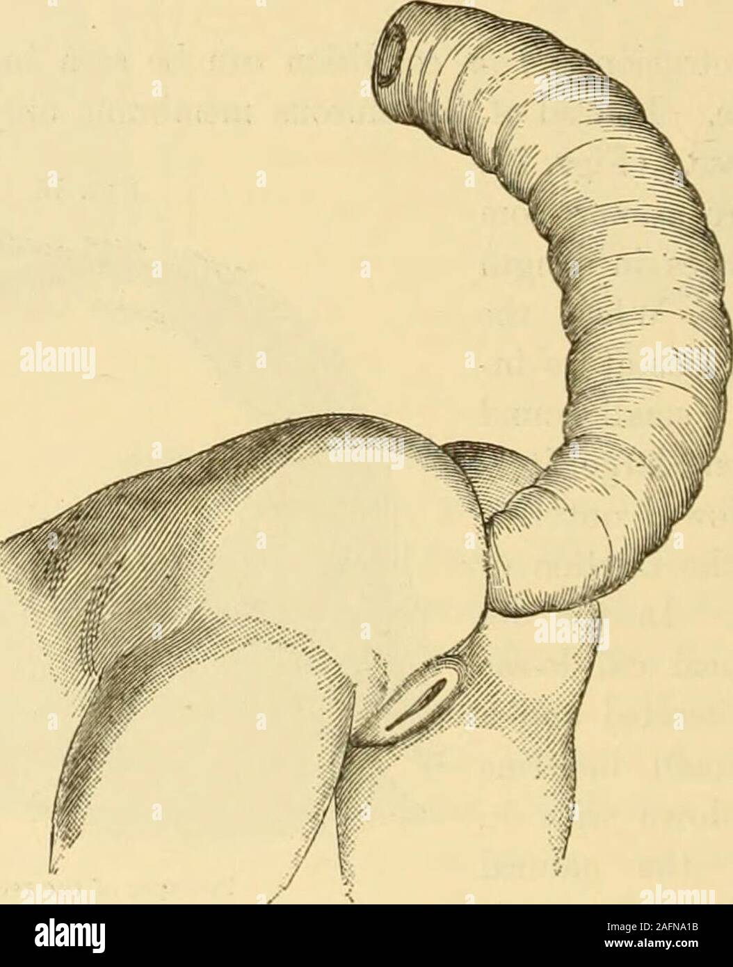 . Clinical gyncology, medical and surgical. Prolapse of the rectum. 902 DISEASES OF THE RECTUM AND ANUS. Subsequently it is covered with pus, or has a grayish hue, showing superficialulcerations. The membrane assumes the character of the skin, losing itsflexibility and sensibility, while its natural furrows gradually disappear.The tumor may attain the size of an orange. It is difficult to reduce it,on account of the hardening and thickening of the submucous tissue, whichprevent it from slipping back. In cases of this degree the sphinctersdilate, lose their tonicity, and no longer prevent the e Stock Photo