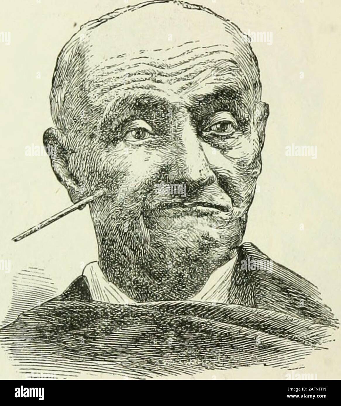 . Practical electricity in medicine and surgery. Fig. 142.—Bilateral Contraction of the Zygomatics Major. The Contractionof the Orbicularis Palpebrarum is also Shown in the Cut. The expression varies according to the intensity of the contrac-tion from attention to astonishment, surprise, and terror. The corrugator supercilii is easily isolated at the outer angleof the brow. (See Figs. 138 and 141.) Effects: Flatteningand depression of the eyebrows, so that the latter overhang theupper lid. The inner ends of the brows are at the same time 166 PRACTICAL ELECTRICITY IN MEDICINE AND SURGERY. drawn Stock Photo