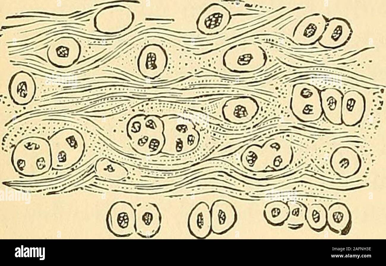 . The principles and practice of surgery. re inthe vicinity of the fracture. When the laceration and displacementare the least, other things being equal, the amount of callus is theleast. It is probable that neither hyperaemia nor inflammation is essen-tial to the repair of lesions in bone, as they are probably not essentialto the repair of lesions in the soft parts; yet these pathological condi-tions are seldom absent in either case, and if they do not materially 240 REPAIR OF FRACTURES. aid in the restoration of divided parts, it is certain that when moderatethey do not prevent such restorat Stock Photo