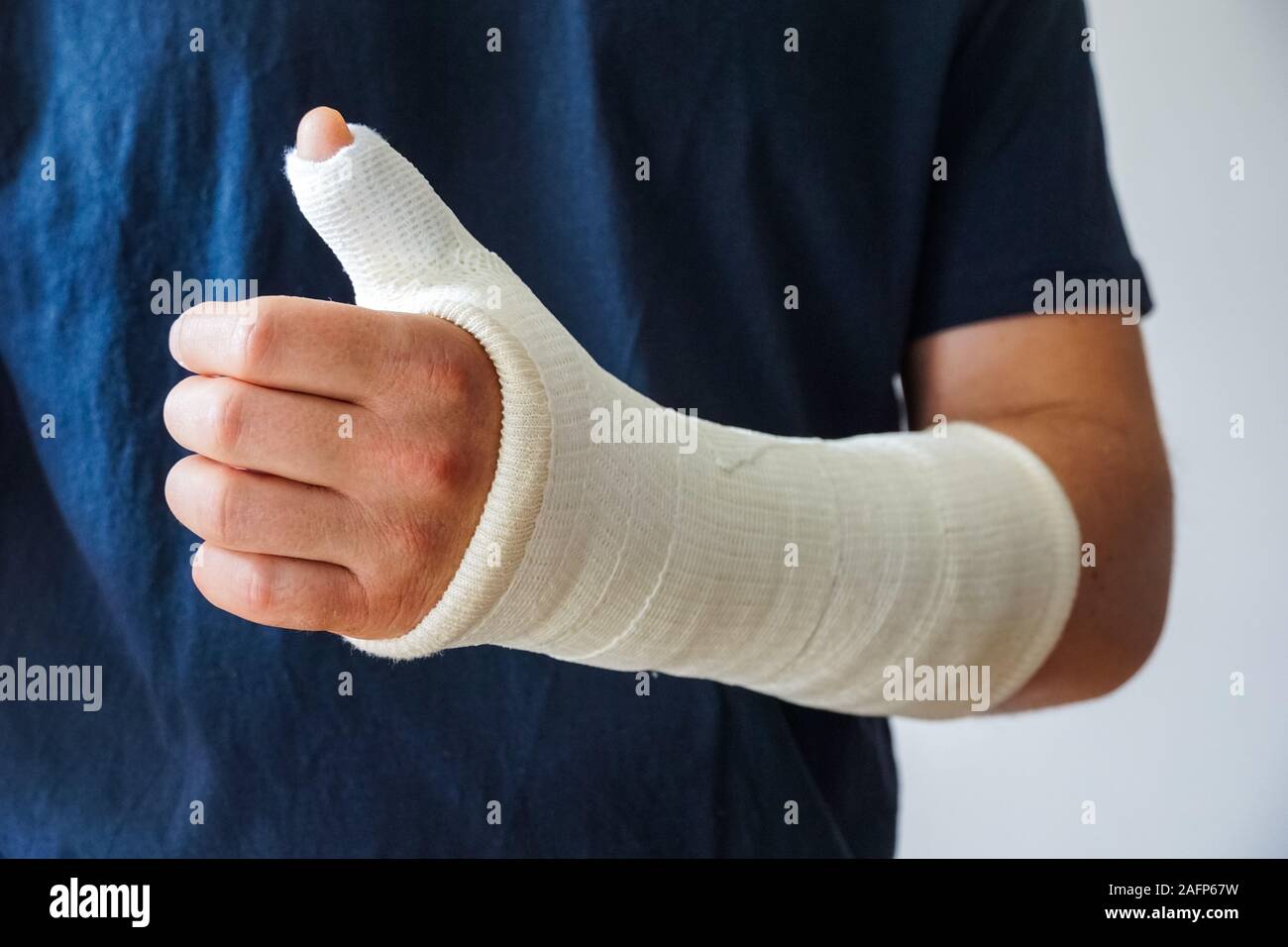 Man with plaster cast on broken hand, broken thumb,broken wrist Stock Photo