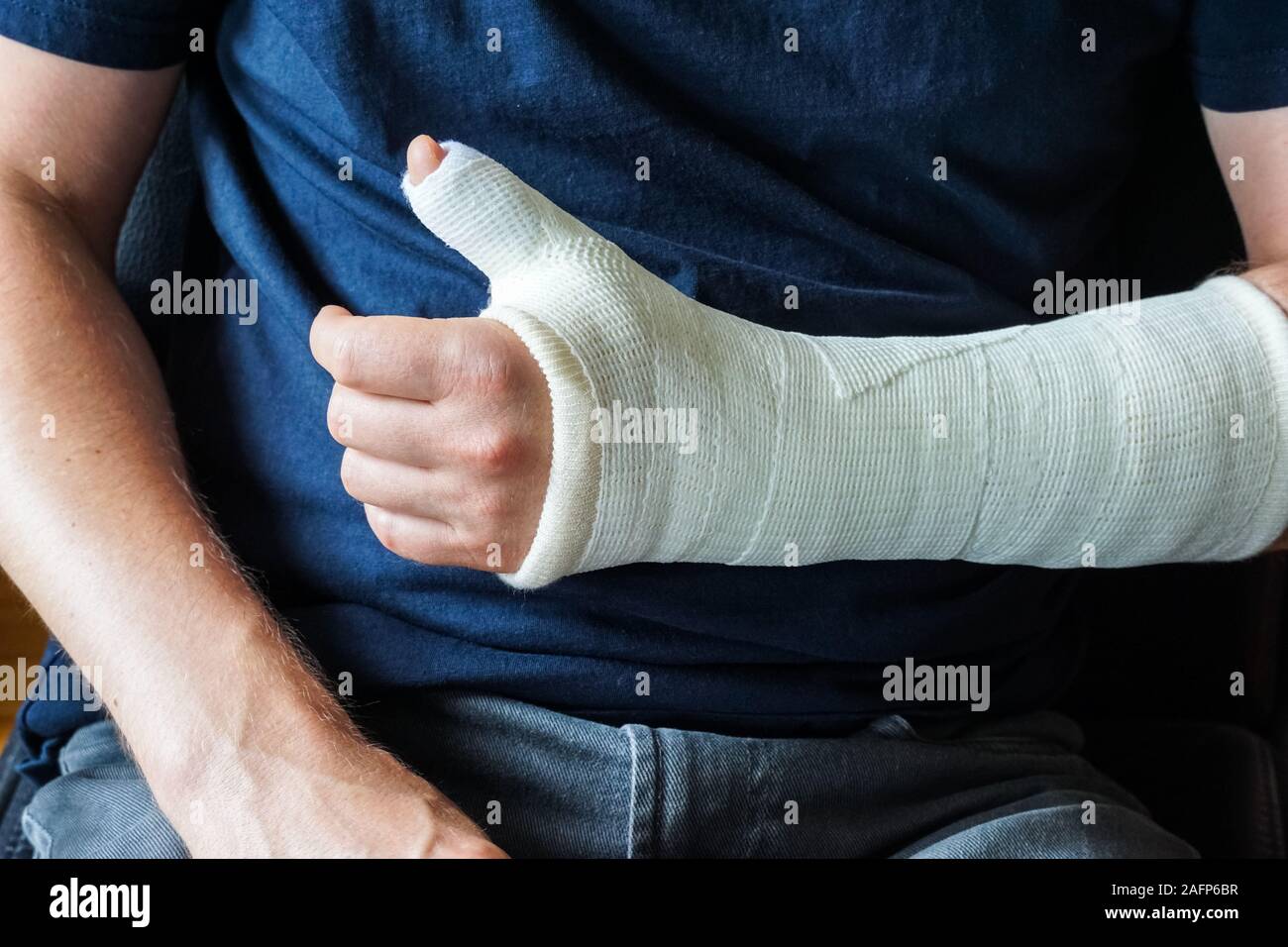 Man with plaster cast on broken hand, broken thumb,broken wrist Stock Photo