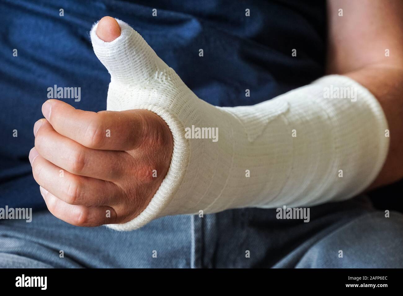 Thumb injuries hires stock photography and images Alamy