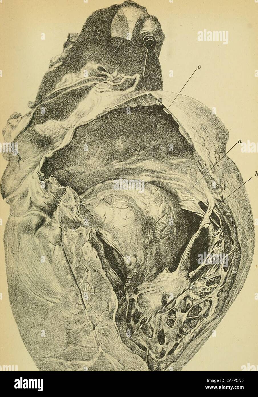 . Diseases of the heart and thoracic aorta. &gt;^^- -r Fig. 243.—Aneurlxm of the left ventricle. {Natural size.) A laree circular opening («) which represents the orifice of the aneurism, is situated in theRpntum ashort distance below the aortic ^p&lt;;raent,s. .,..., nr t ™,VH V,v Pvnfessor Turners penuission from a specimen in the Anatomical Museum of Copied by Professor Turners permissionthe Edinburgh University. MH«.i.lC.-»MC.L.inonoiM;. Fig. 244.—Aneurism oft/ie septum veiUnculoTum {tite same preparation represented in Jig. 243), seenfrom the iirftrior of the right ventricle. {Natural siz Stock Photo