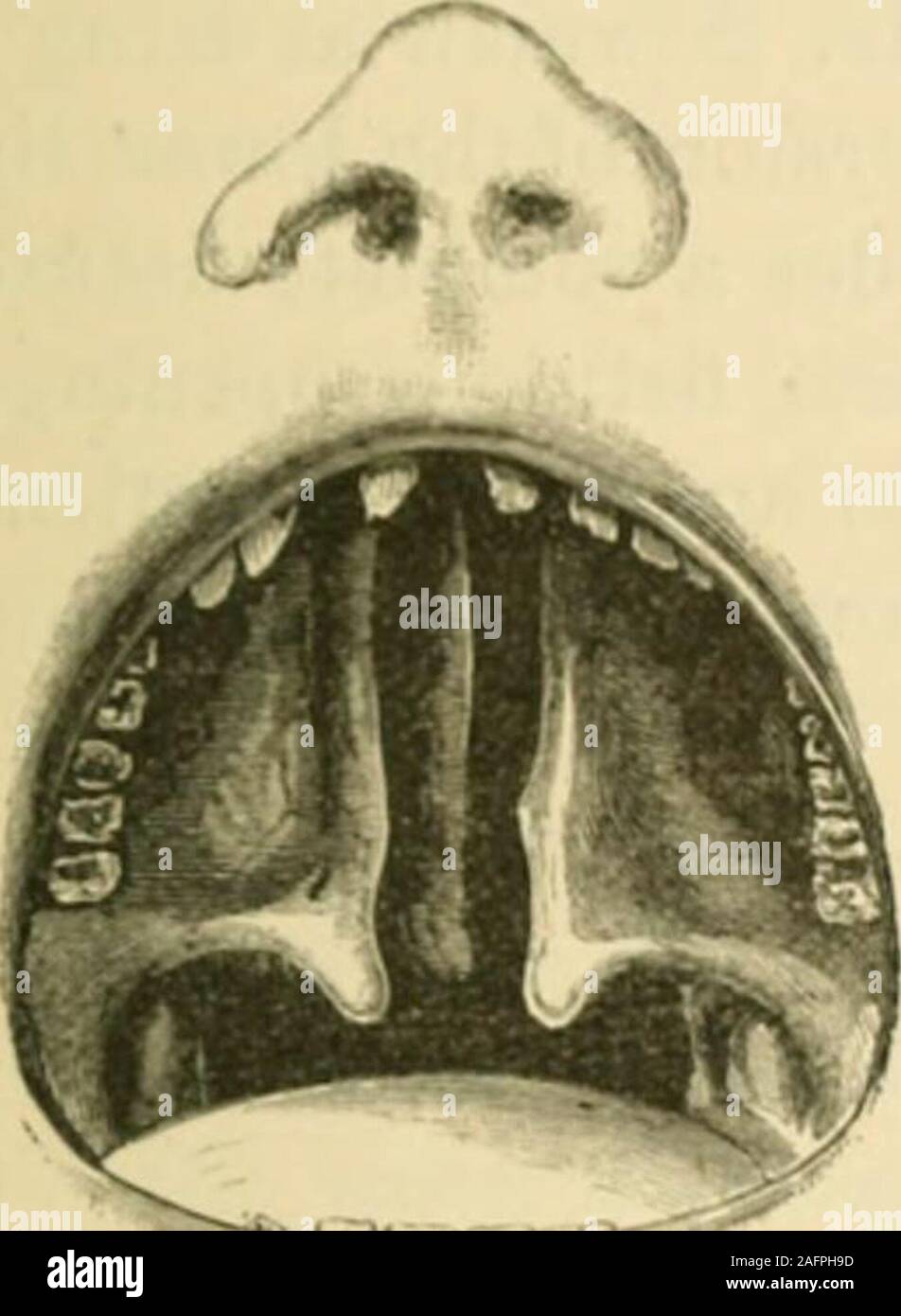 . St. Thomas's Hospital reports. or double, the alveolus in front will l)e more or less involved(fig. 4). On examining the roof of the mouth in these cases thevomer may in some examples be seen to be i)laced free and n,i CIrfl Palate. SI exactly in the median line, so that a probe may be passed intothe nasal cavity of either side (fij;s. !• and r»); whilst in other in-stances the septum is attached to one or other lialfof the palate,thus shuttinj^ oft the cavity of the nares of that side from thebucca cavity (fij;. G). Referrin*; to this point, Rouge states thatthe vomer is most frequently att Stock Photo