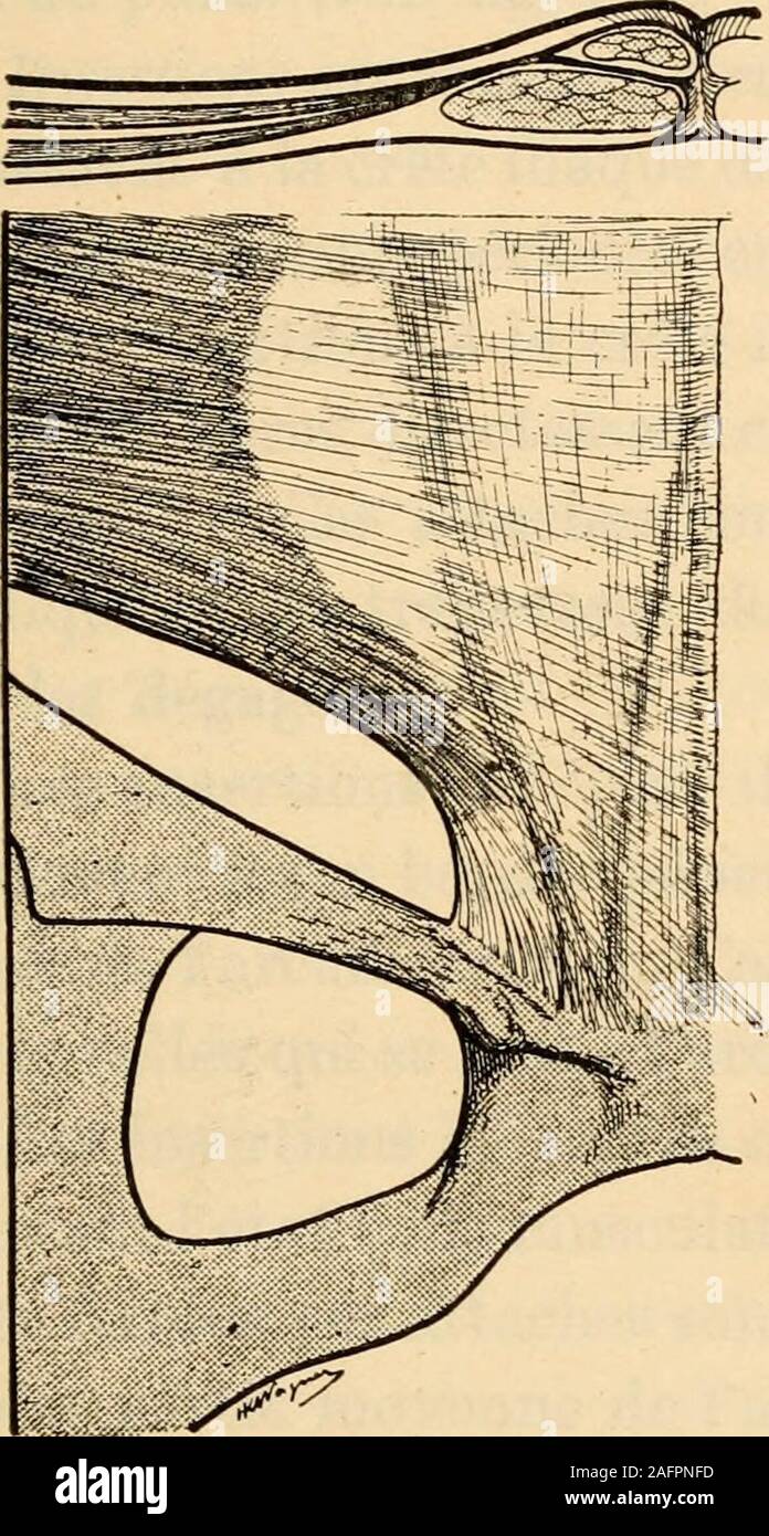. Anatomie médico-chirurgicale de l'abdomen. Fi&lt;;. 7. — Le muscle petit oblique de labdomen (daprès Poirier) IV. Paçe 24. R. Grégoire. Planche VIII (pages 24-25],. Fig. 8. — Les attaches internes desfibres du petit oblique nées delarcade crurale. Les fibres supé-rieures contribuent à former lagaine du pyramidal. L es fibres in-férieures contribuent à former letendon conjoint. L e schéma situé en haut de lafigure montre une coupe de laparoi abdominale faite au-dessusdu pubis. 1 e petit oblique et letransverse forment la gaine dumuscle pyramidal, en arrière dutendon aponévrotique du grandobli Stock Photo