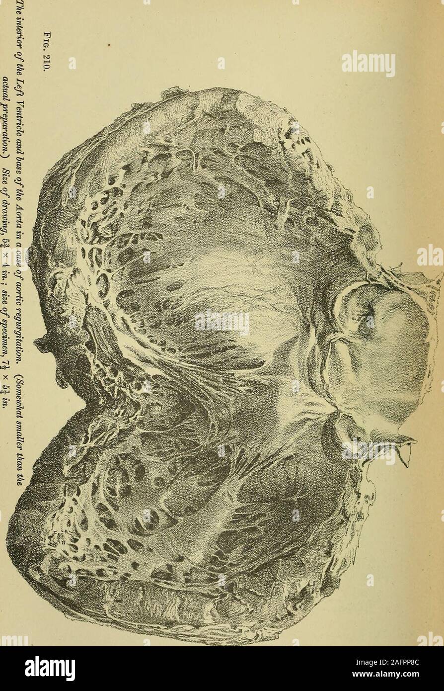 . Diseases of the heart and thoracic aorta. Fig. 209. Atheroma of the hose of the Aorta: Obstruction of the orifices of the Coronary Arteries ;Extreme incompetence of Ike Aortic Valve. {Natural size.) The base of the aorta is markedly atheromatous, and contains several large, flat, smoothcalcareous plates; the orifice of one of the coronary arteries (a), is completely occluded, whilethat of the other (fr) is very much narrowed; the segments of the aortic valve are thickenedand crumpled; the valve was extremely incompetent. M°UiAHJiCu&gt;iMii.e,LiT)ic?.Ei&gt;i r g 5 o ° I. yEtiology and Patholo Stock Photo