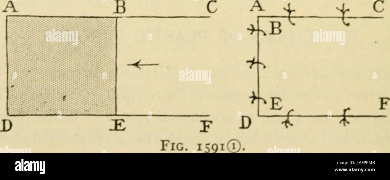 . Manual of operative surgery. Fig. 1590. grafting or by the use of pedunculated flaps of healthy skin, obtainedpreferably in the near neighborhood, occasionally from more remote parts.The skin chosen to form the flaps must be such as to match that lost. Itwould not gratify a patient much to have a successful rhinoplasty per-formed on him if the hairy scalp was used to supply the necessary skin forthe nose. The objection to many of the operations for ectopia vesicae or. for epispadias is that skin capable of growing hair is used to line the newbladder or urethra. Hairless skin is often used to Stock Photo