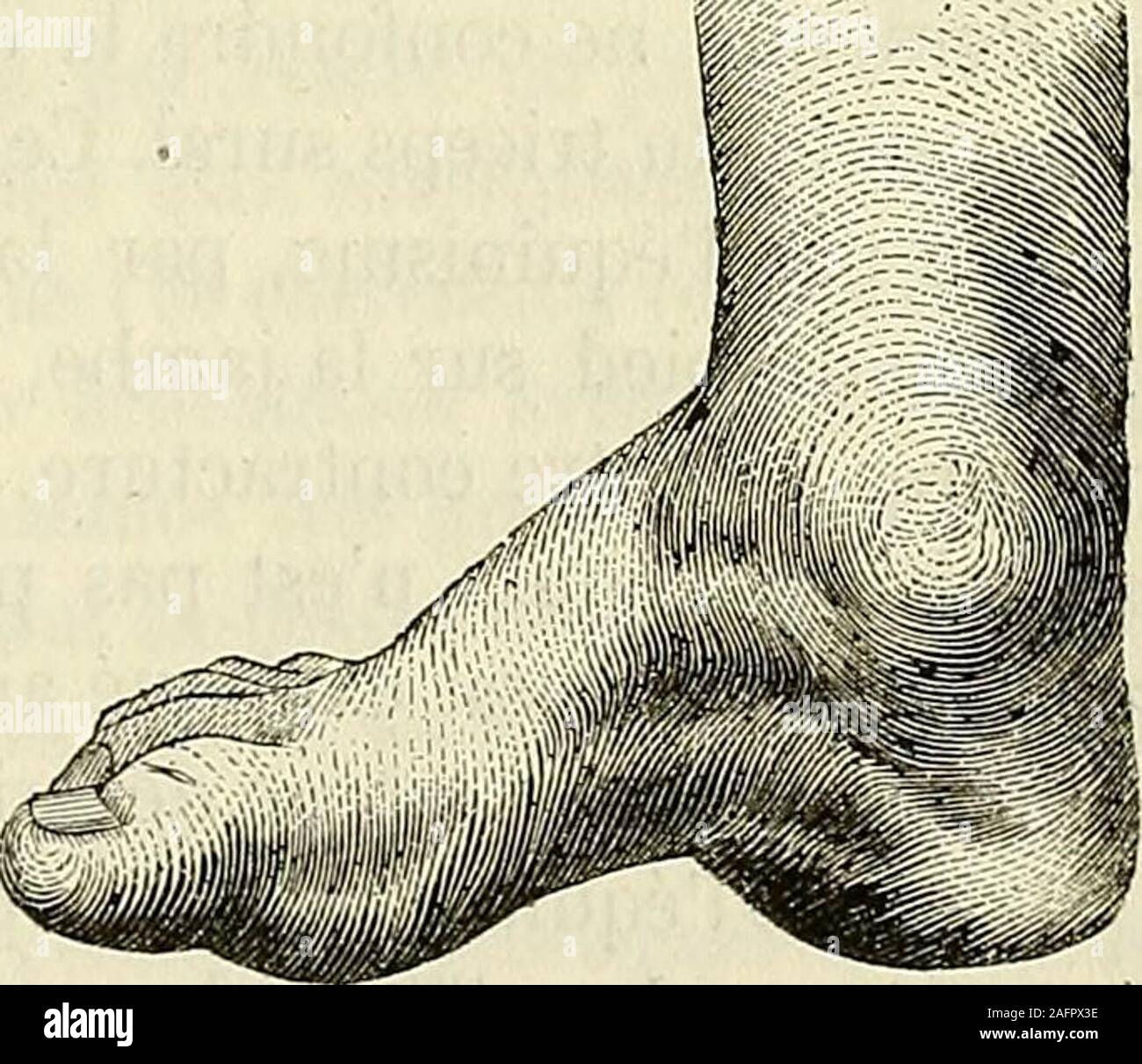 . De l'électrisation localisée et de son application a la pathologie et a la thérapeutique. FiG. 171. FiG. 172. ronier latéral ; 2° la griffe pied creux par excès daction des exten-seurs des premières phalanges, consécutivement à la paralysie desmuscles interosseux, fléchisseur etadducteur du gros orteil (voy. lafig. 171) ou à la contracture dutriceps sural (dans léquin) (voy. lafig. 172) ; 3° le pied creux talus parinflexion de lavant-pied sur lar-rière-pied, consécutivement à laparalysie ou à latrophie du tricepssural (voy. la fig. 173). Tous cespieds creux ont entre eux quelque |ressemblanc Stock Photo