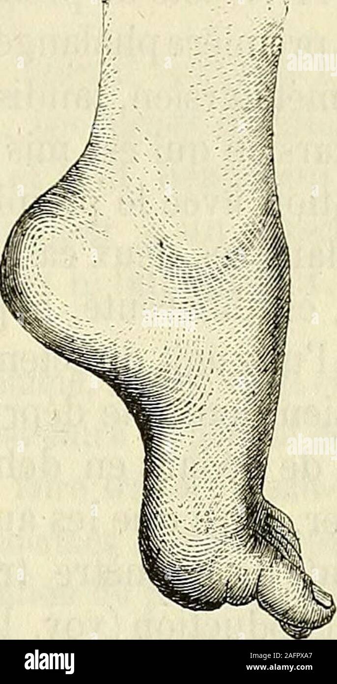 . De l'électrisation localisée et de son application a la pathologie et a la thérapeutique. FiG. 171. FiG. 172. ronier latéral ; 2° la griffe pied creux par excès daction des exten-seurs des premières phalanges, consécutivement à la paralysie desmuscles interosseux, fléchisseur etadducteur du gros orteil (voy. lafig. 171) ou à la contracture dutriceps sural (dans léquin) (voy. lafig. 172) ; 3° le pied creux talus parinflexion de lavant-pied sur lar-rière-pied, consécutivement à laparalysie ou à latrophie du tricepssural (voy. la fig. 173). Tous cespieds creux ont entre eux quelque |ressemblanc Stock Photo