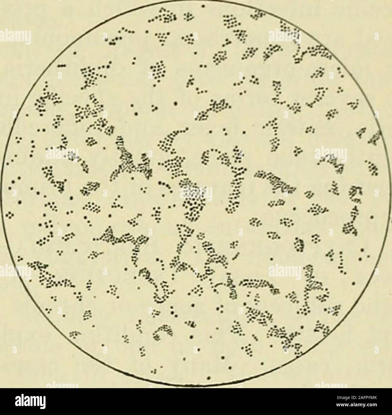 . Internal medicine; a work for the practicing physician on diagnosis and treatment, with a complete Desk index. Fig. 254.—Streptococcus pyogenes. Fig. 255.—Staphylococcus pyogenes aureus. the tegumentary structures are especially involved in septic inflammatoryprocesses, such as forms of erythema, scarlatiniform eruptions, malignanterysipelas, and acute septic phlegmon. Subcutaneous hemorrhages are com-mon. Finally, we recognize a great group of cases in which inflammatoryand suppurative disease of the various viscera, as for example, the lungs,kidney, liver, stomach, and intestines or spleen Stock Photo