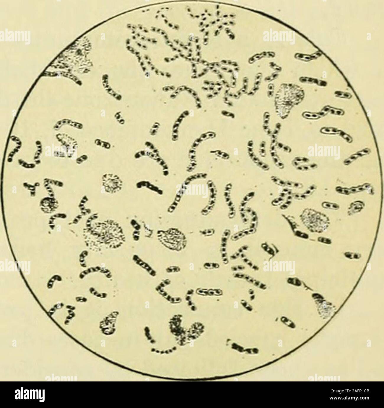 . Internal medicine; a work for the practicing physician on diagnosis and treatment, with a complete Desk index. commonly in pairs, eachmember being lancet-shaped, occasion-ally in chains of four or six cocci. Inpreparations from the lesions or fluidsof animals and man the pairs are en- Fig. 242.—Spread of sputum showing pneumo-closed in a capsule. In cultures the cap- ° ^ ^^^^ ^^ ^^^ sule is frequently ateent. The pneumoeoccus occurs in many other diseases,especially bronchopneumonia, pleurisy, endocarditis and pericarditis,meningitis, peritonitis, in forms of arthritis, and in middle-ear dis Stock Photo