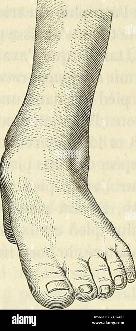 . De l'électrisation localisée et de son application a la pathologie et a la thérapeutique. FiG, 130, FiG. 131. A ce moment, larticulation tibio-tarsienne est condamnée à linac-tion. Mais le sujet y supplée alors en mettant instinctivement enmouvement son articulation calcanéo-astragalienne à laide dumuscle qui produit la flexion abductrice, avec son long extenseurdes orteils. (Je démontrerai par la suite que le mouvement dab-duction qui se passe dans larticulation calcanéo-astragalienneélève aussi la pointe du pied. Ce mouvement de flexion abductriceest dautant plus grand, plus exagéré, que l Stock Photo