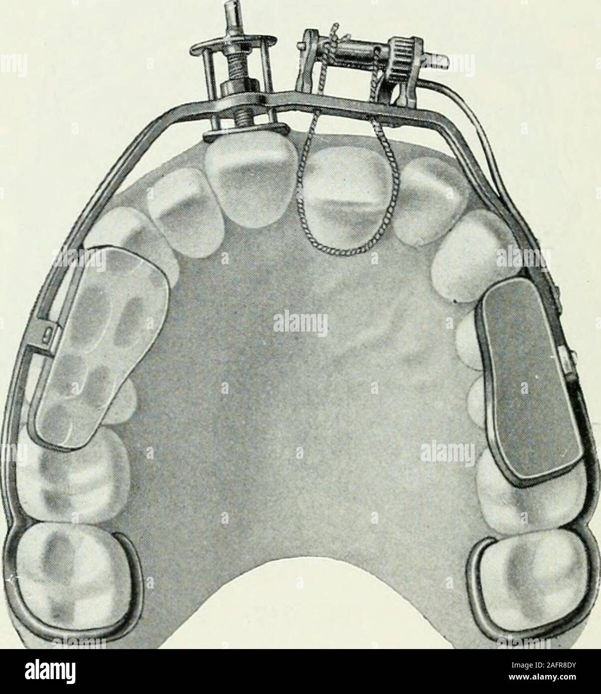 . Lehrbuch der orthodontie fur studierende und zahnartze mit enschluss der geschichte der orthodontie. ibung in der gewünschten Lage festgehalten. Bißer-höhung wird erreicht durch Elfenbeinklötzchen, che auf denZahnkronen liegen and durch einen Metallbügel an dem labialenBogen festgenietet sind. Der Franzose Marmont :r) (1844) nahm für sich die Priori-tät der Kieferdehnung in Anspruch. Bei Schiefstand des Augen- :;:) L. V. 60.Pf äff, Orthodontie. 21 322 Geschichte der Orthodontie. zahnes riet er, den ersten Mahlzahn, sofern er krank wäre, zuentfernen und die beiden Prämolaren nach rückwärts zu Stock Photo