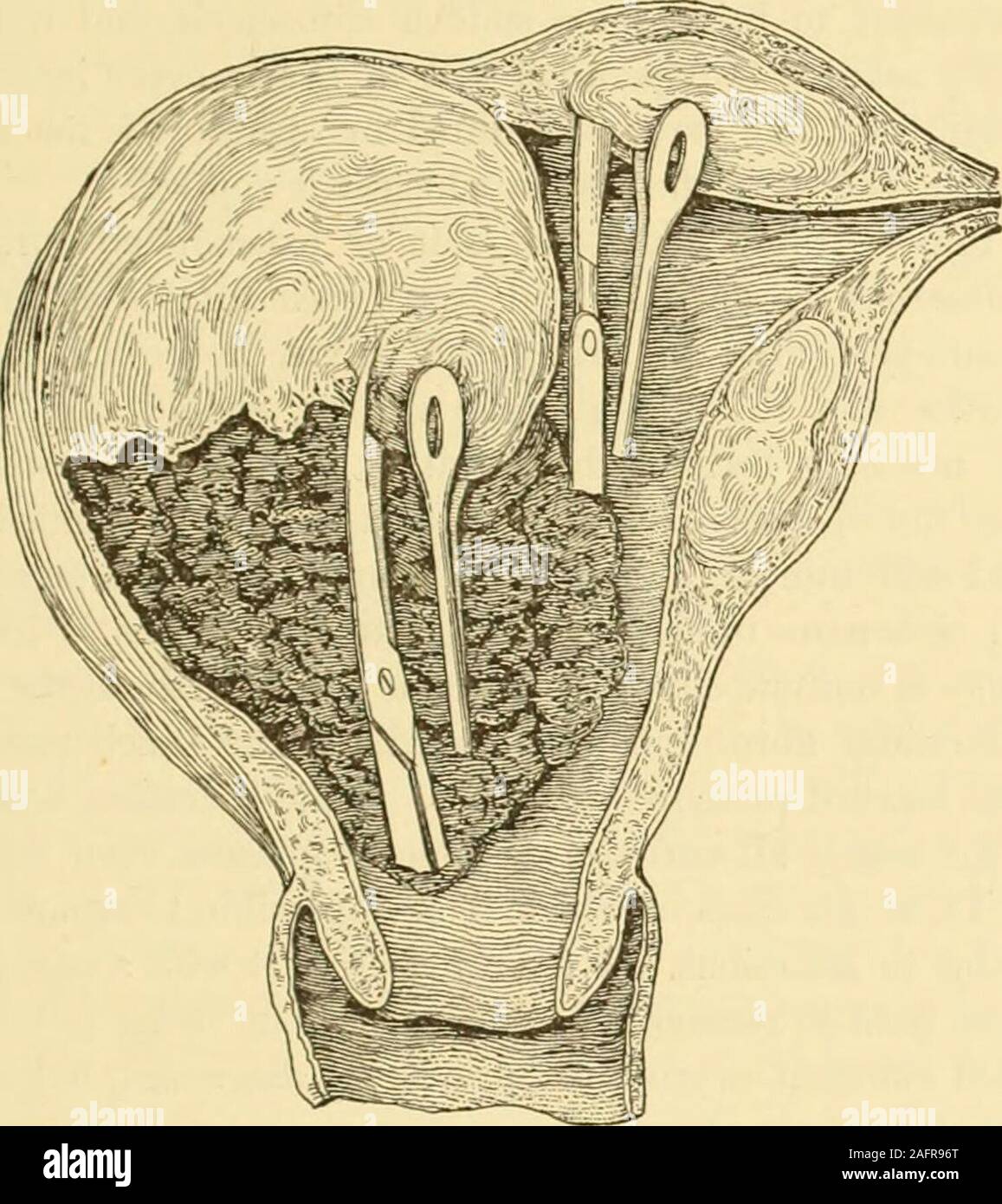 . Clinical gyncology, medical and surgical. Bullet forceps. and the posterior lip of the cervix. The tumor is examined with the fingerto determine its relations with the uterus, and then an incision is made BEMGX NEOPLASMS OF THE UTERUS. 571 directly into the growth, which has been grasped by a strong volsella anddrawn forcibly downward ; a piece is thus cut out with scissors or knife.In this manner the process is continued until the entire growth is re-moved, the Museux forceps being replaced at times by dentated cyst-for-ceps or by the serrated forceps of Pean. Large pieces of the tumor may Stock Photo
