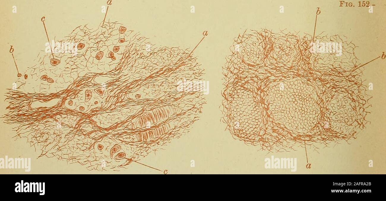 . Diseases of the heart and thoracic aorta. Fig. 150.—A portion of the preparation slwwn in jig. 149 more highly magnijied, about250 diameters, showing thejnnction of the spindle celled tissue, and the lymph layer.Large masses of lymph ( l, I,) are becoming convertedinto spindle cells (s, s.) Fig. 151. Fig. 152.. Fig. 151.—A por/ion of the central lymph layer of the preparation shovm in fg. 149,magDified about 200 diameters, slowing lymph threads (a), leucocytes (b), andlarge epithelial cells (c). Fig. 152.—Another portion of the central lymph layer of the preparation shown infig. 149; sho-win Stock Photo