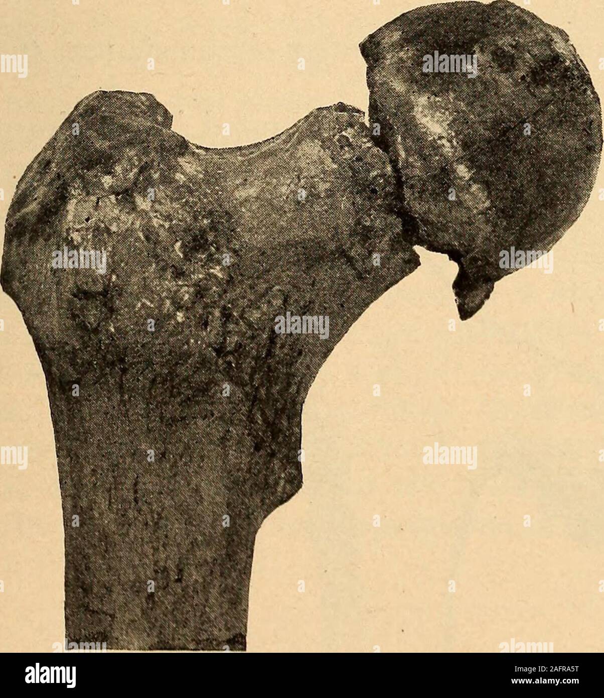 . A practical treatise on fractures and dislocations. sometimes smooth or irregularon the side of the head, while theneck on the other side is crushedor comminuted. Angular deviation at the fracture is the rule, the apex of the anglebeing usually directed forward and upward, and is habitually effected by crushing of the bone or byFig. 229. penetration of one fragment into the other. This penetration orimpaction is rarely more than asimple interlocking of the irreg-ularities of the surface, althoughBigelow ^ reported one in whichconsiderable force was requiredto separate the fragments ; pos-sib Stock Photo