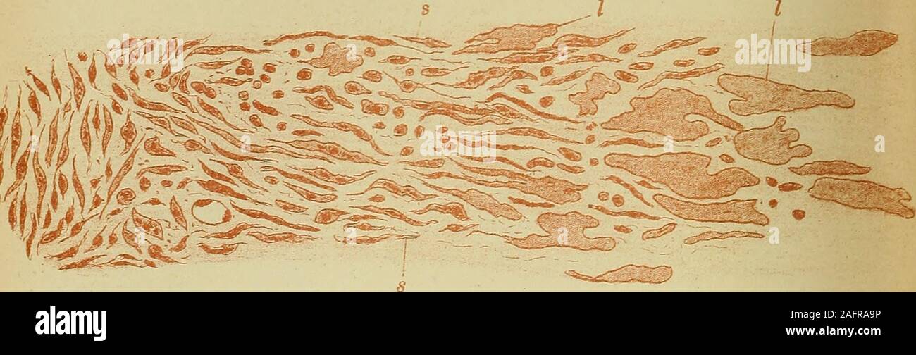 . Diseases of the heart and thoracic aorta. Fig. 150.—A portion of the preparation slwwn in jig. 149 more highly magnijied, about250 diameters, showing thejnnction of the spindle celled tissue, and the lymph layer.Large masses of lymph ( l, I,) are becoming convertedinto spindle cells (s, s.) Fig. 151. Fig. 152. Stock Photo