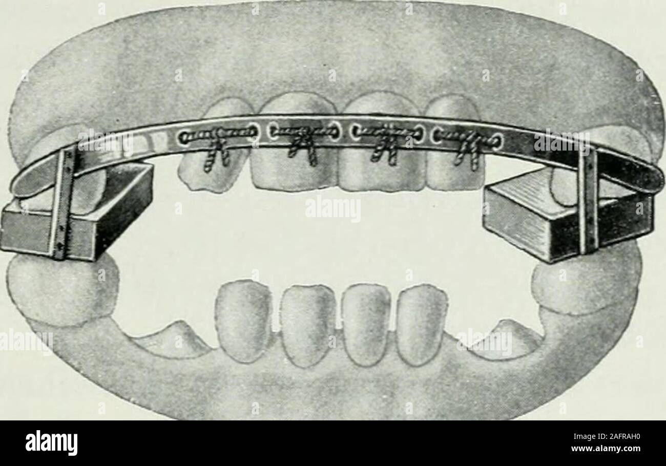 . Lehrbuch der orthodontie fur studierende und zahnartze mit enschluss der geschichte der orthodontie. ten Mahlzähnen erstreckte, diezur Befestigung dienten. Dieser Apparat war für diejenigenFälle bestimmt, in denen die Zähne nach innen, nach dem Gau-men zu. durchgebrochen waren. Den zu regulierenden Zähnengegenüber waren Löcher zum Befestigen der Ligaturen gebohrt.Durch fortgesetztes Erneuern der Ligaturen wurden die Zähnenach außen in ihre normale Stellung gebracht. In den Fällen,wo der Biß erhöht werden mußte, um die Zähne nach außenbringen zu können, befestigte er an den Enden des Goldband Stock Photo