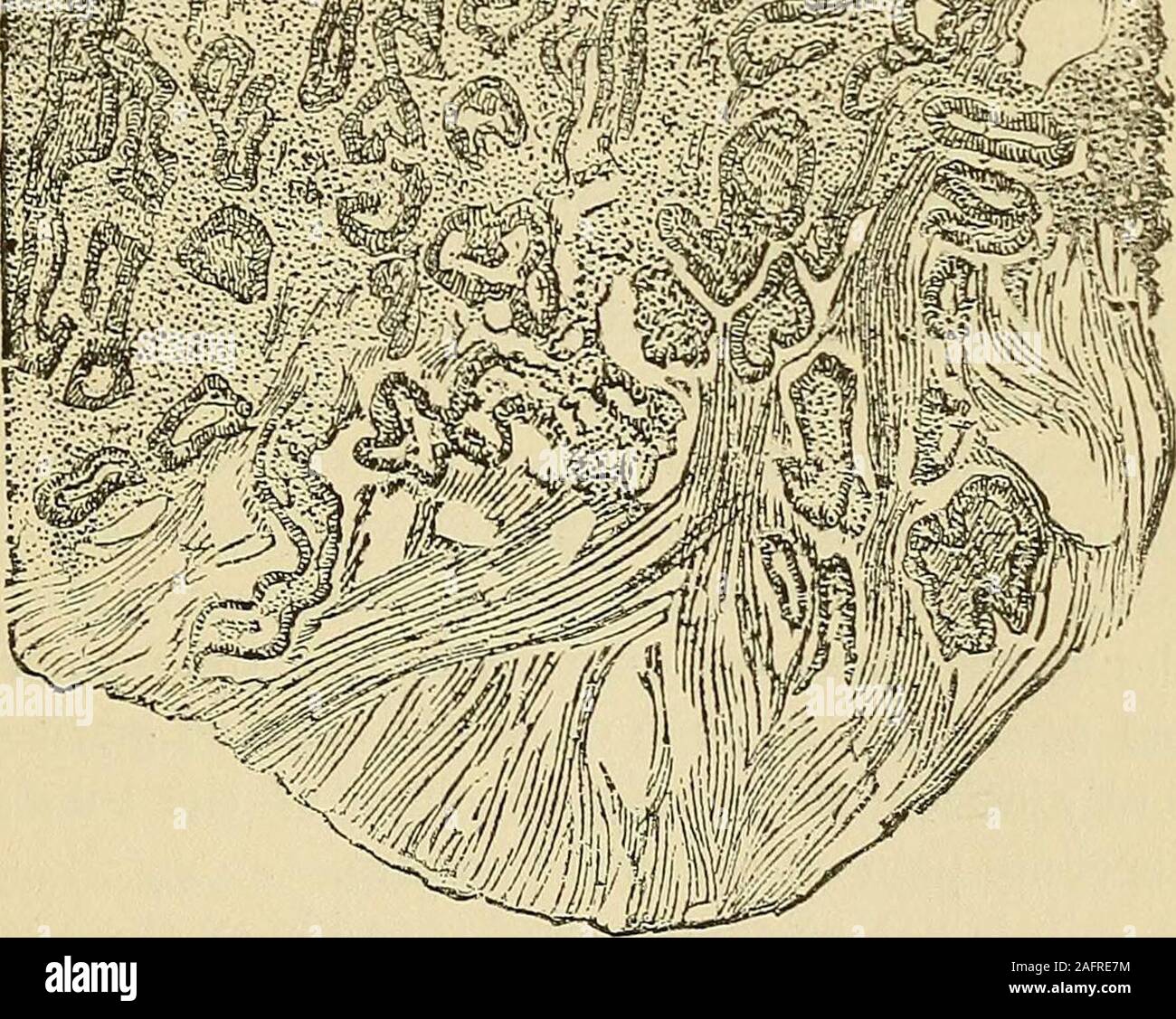 . Cyclopædia of obstetrics and gynecology. Fig. 22.—Hypertrophy op Mucous BIembrane (endometritis glandularis) in Uterine Fibroma.(Specimen of Z)r. Wyder.) specimens they were closely crowded and appeared like cork-screws placedperpendicularly to the surface. In other cases the mucous membranepresented a more areolar appearance. Dilated, but not cystic glandtubules were found in these. The tubules were separated from each 212 NEW GROWTHS OF THE UTERUS. other by broad trabecles of interglaiidular connective tissue. Wyderfurther emphasizes the fact that these clianges resemble the conditionknown Stock Photo