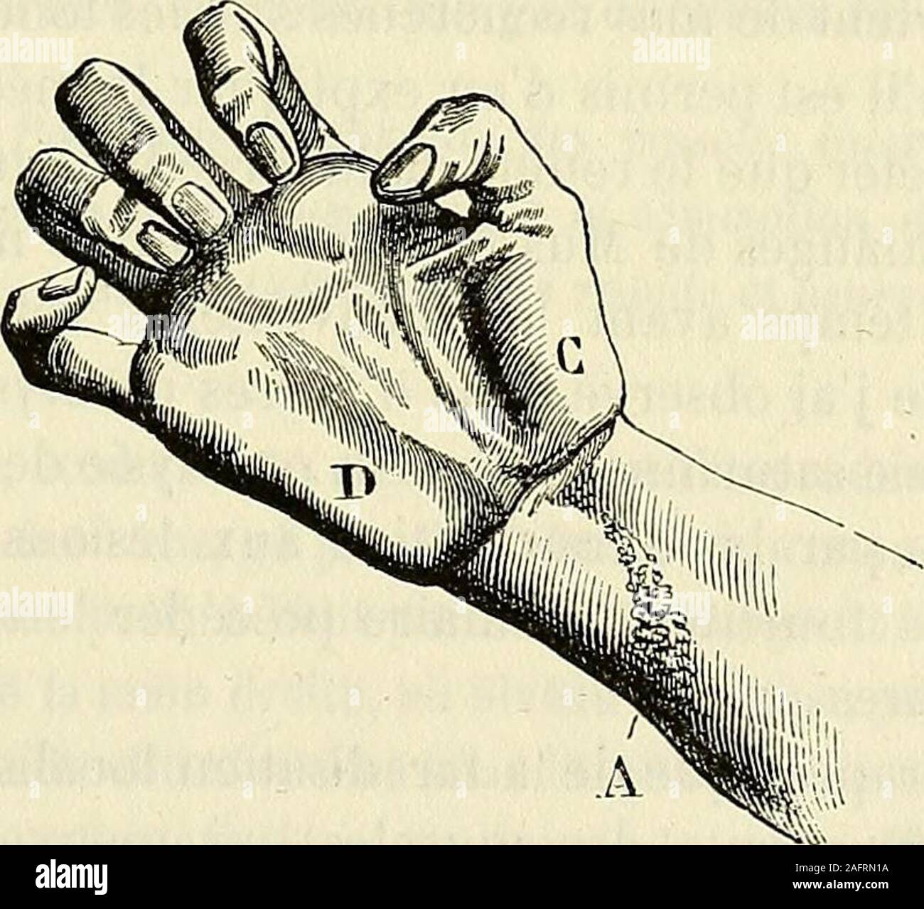 . De l'électrisation localisée et de son application a la pathologie et a la thérapeutique. FiG. 36. — Attitude de la main de Musset tenant une plume pourécriref après le trailement. rapide, que Musset put, au mois daoût, écrire et dessiner, et bien quil eûtinterrompu son traitement pendant plusieurs mois et à plusieurs reprises,les premières phalanges de lindex et du médius se fléchirent à angle droitsur les métacarpiens ; les deux dernières sétendirent complètement ; quantà lattitude et aux mouvements volontaires des deux derniers doigts, ilsfurent aussi en voie damélioration, et il nest pas Stock Photo
