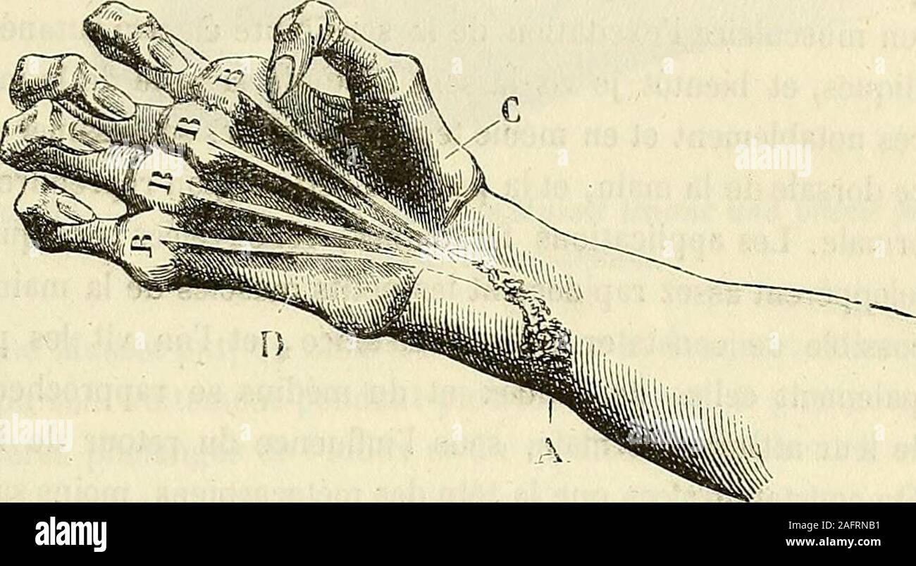 . De l'électrisation localisée et de son application a la pathologie et a la thérapeutique. Fig. 34. Attitude vicieuse de la main de Musset vue jiar sa face dorsale, avant le IraUe-mçnl.—La lésion du nerf cubital a été suivie de latrophie des interosseux et desdeux derniers lombricaux. —Les muscles de lavant-bras jouissant de leurs pro-priétés et se trouvant privés de leurs modérateurs, les phalanges ont été entrai- EXPOSITION DES FAITS. — PARALYSIES ANCIENNES. 203 nées dans des directions vicieuses, et la main a pris la forme dune grille. —La dépression A indique lorigine de la cicatrice occa Stock Photo