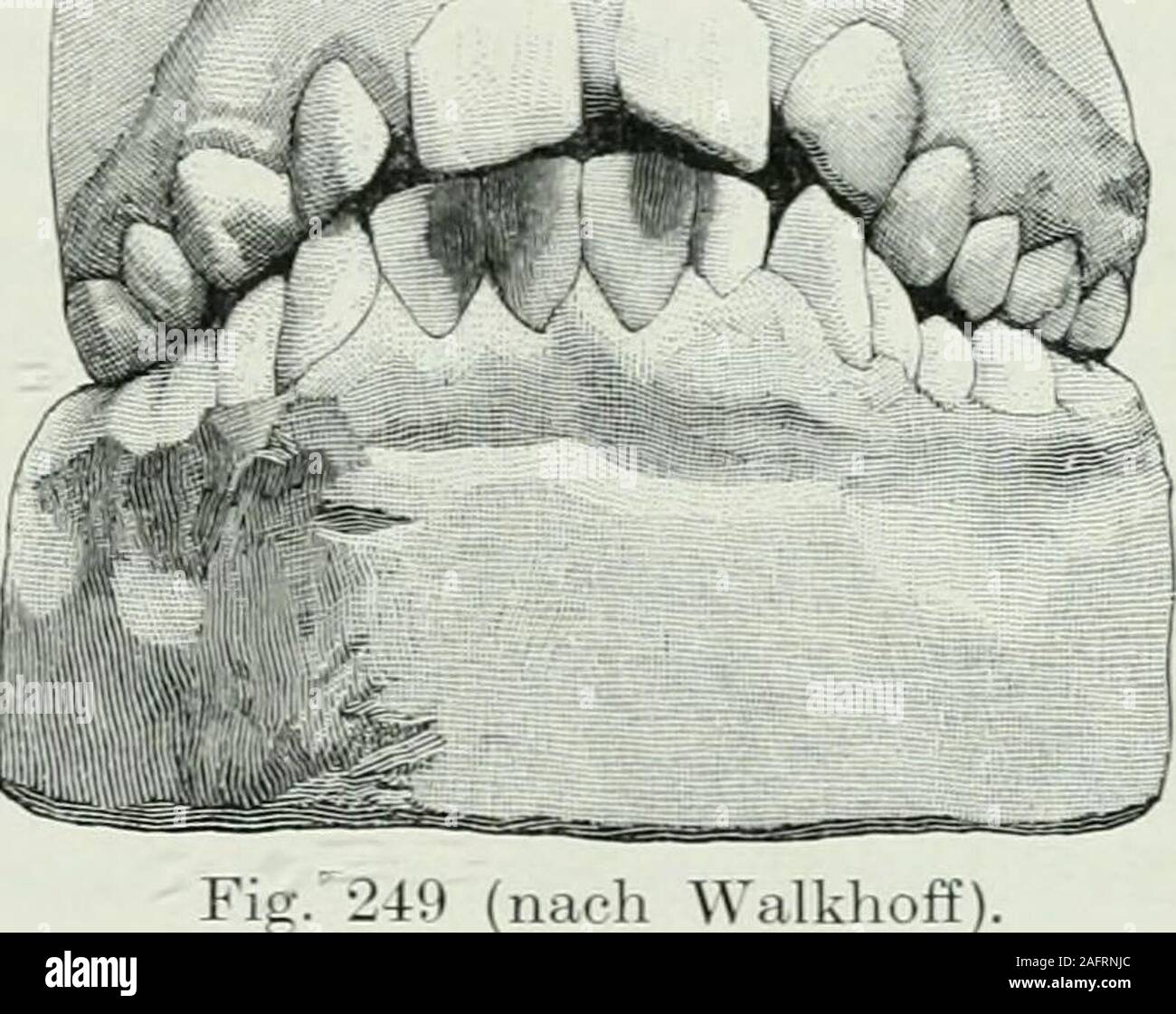 . Lehrbuch der orthodontie fur studierende und zahnartze mit enschluss der geschichte der orthodontie. Fig. 248 (nach Walkhoff).. i Walkhoff). loren geht, zum anderen aus den angeführten Gründen nichtausgenutzt wird und verheerend wirkt. In vereinzelt dastehenden Fällen, die ich im Schlußkapitelabgehandelt habe, mag es angezeigt erscheinen, einen Zahn zuextrahieren. Das sind aber Ausnahmen. Insbesondere kann manbei unbemittelten Patienten genötigt sein, zu einer Extraktionseine Zuflucht zu nehmen, aber auch in diesem Falle sind nachMöglichkeit die geeigneten Apparate anzuwenden, um das, wasman Stock Photo