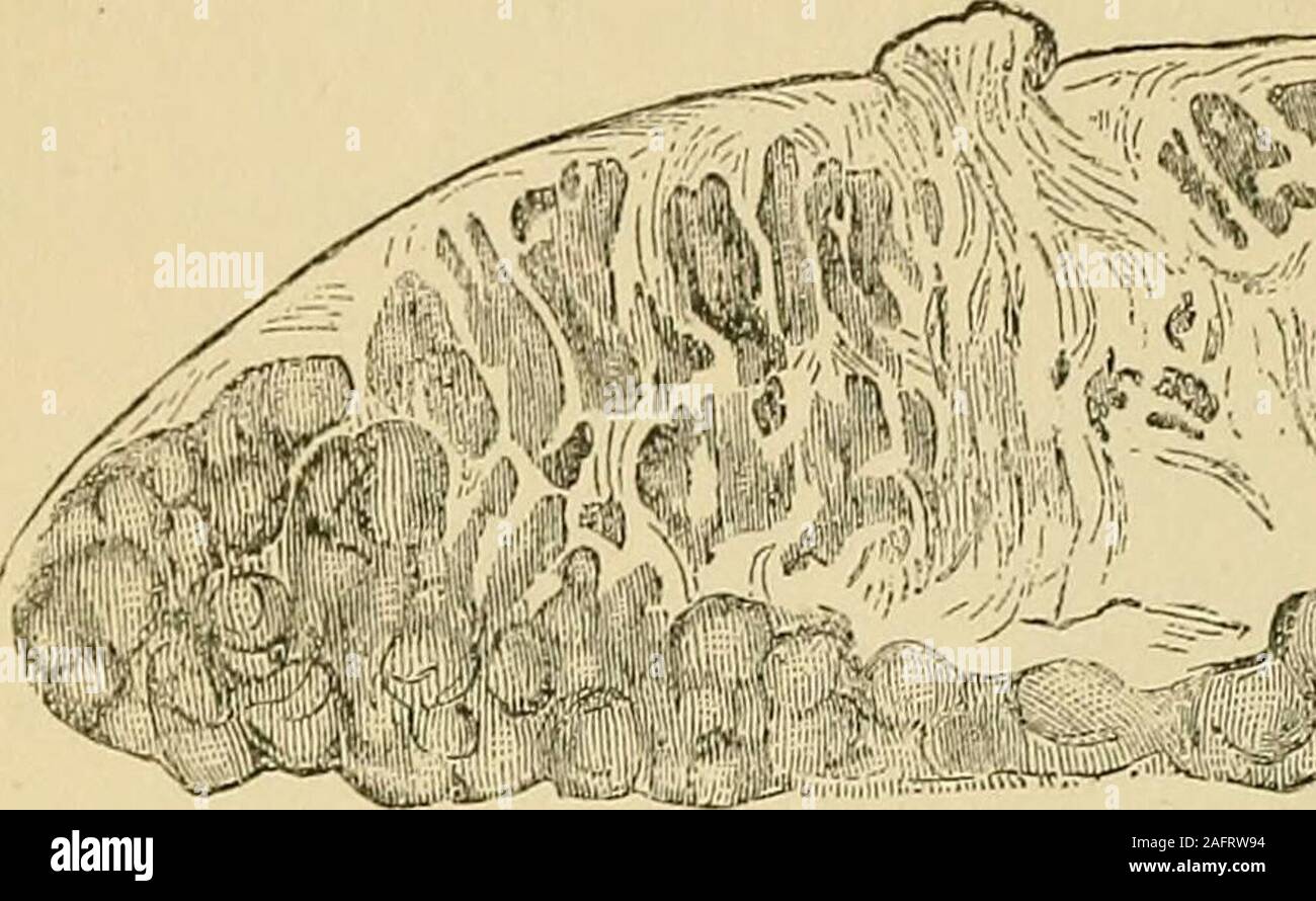 . Cyclopædia of obstetrics and gynecology. FiG. 40.—Two Isolated Cancerous Nodules in a still well-developed Mamma. One-halfnatural size. plied to every kind of induration, whether due to a neoplasm or a chronicinflammatory process (these two were not as distinctly separated as now).The designation scirrhus degeneration, formerly did not include malig-nancy. It was in the beginning of the present century that it first be-came more and more the custom to use the expression schirrhus for theharder, and fungus medullaris for softer neoplasms, while for thechronic inflammatory indurations the desi Stock Photo
