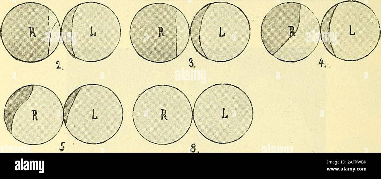 . Physiologische und klinische Untersuchungen Ã¼ber das Gehirn, gesammelte Abhandlungen. ¤tte, da die Stelle A^ gÃ¤nzlich undder angrenzende Theil der I. Urwindung grÃ¶sstentheils zerstÃ¶rt wordenwar, die Stelle des deutlichen Sehens und ein Theil des temporalenGesichtsfeldes dauernd rindenblind sein mÃ¼ssen. Es trat aber zunÃ¤chsteine typische temporale Hemianopsie auf, die sich derart verlor, dassgerade die Stelle des deutlichen Sehens bereits am 6. Tagewieder functionsfÃ¤hig war, wÃ¤hrend Rindenblindheit irgend einesTheiles des Gesichtsfeldes Ã¼berhaupt ausblieb. Beol&gt;aclitimg- TO. Aufde Stock Photo