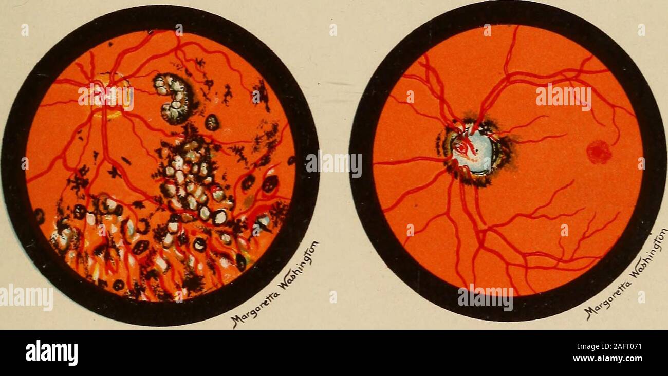 . Medical diagnosis for the student and practitioner. Fig. i. Atrophy