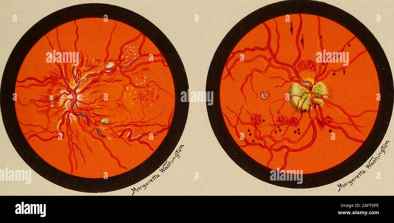 Red reflex eye hires stock photography and images Alamy