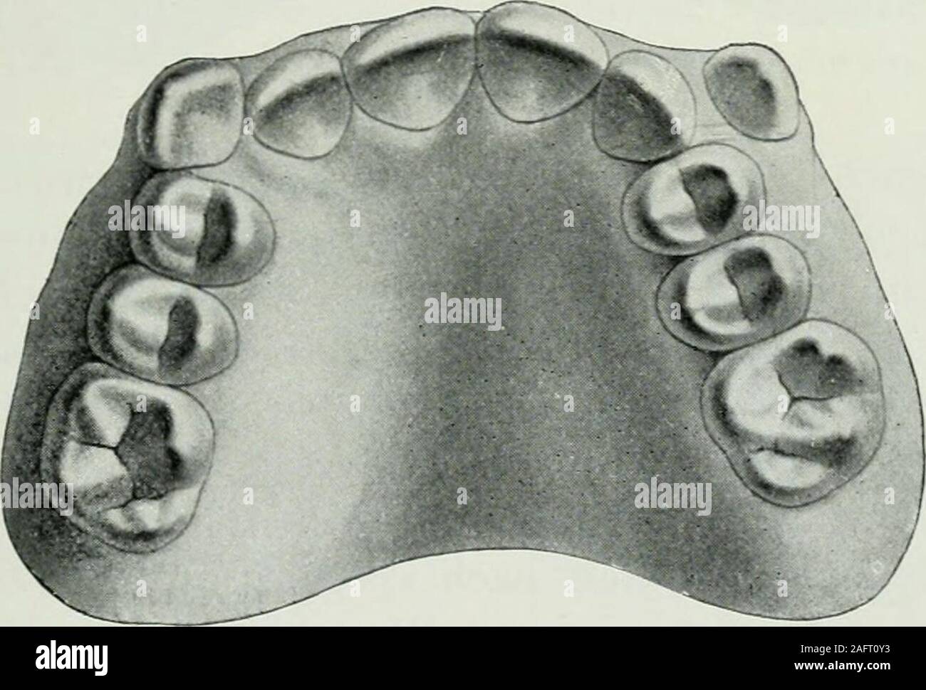 . Lehrbuch der orthodontie fur studierende und zahnartze mit enschluss der geschichte der orthodontie. Fig. 208. bemerkt, um so nachteiliger, als gerade diese Zähne auf denäußeren Eindruck der Physiognomie den größten Einfluß aus-üben. Fig. 209 gibt den hierzu gehörigen Oberkiefer von der Kau-. Fig. 209. fläche aus gesehen wieder. Wie die Dehnung vorgenommen wurde,zeigt Fig. 210, welche die Ansicht des Oberkiefers von unten mitangelegtem Apparate (Dehnung nach der Seite und nach vorne)darstellt. Nach der bereits erläuterten Methode wurde eineDehnung vorgenommen, und die vier Schneidezähne hier Stock Photo