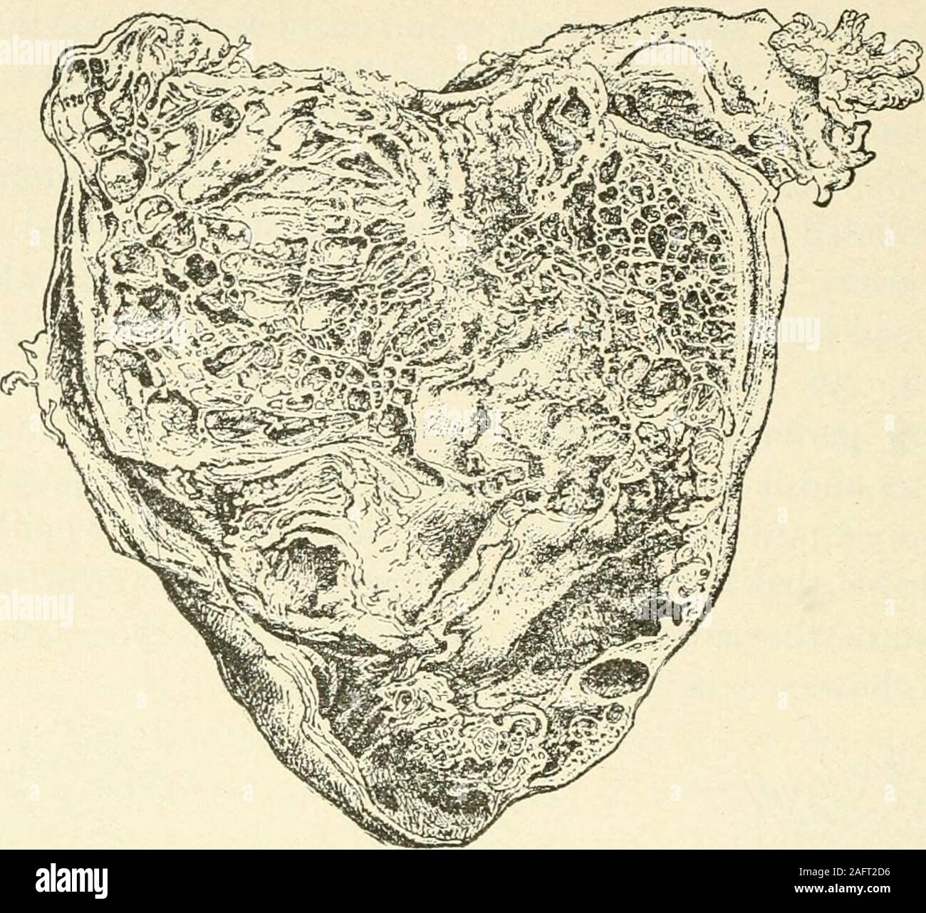 . Annual of the universal medical sciences. Fig. 2.—PAPiLiiOMA of the Ovary. {^New York Medical Journal. The malignant character of these growths is doubted byStewart Paton,„ii9 altliougli it is true that the tumors recur.While they begin on the ovary, growths may occur in the uterus,tubes, broad ligaments, bladder, and ovaries, or reflections of theperitoneum. Recurrence takes place by direct implantation, andnot by metastasis. There is no more clinical evidence for callinga papilloma malignant than there is for placing the myxo-adenomain the class of malignant neoplasms. In addition to the n Stock Photo