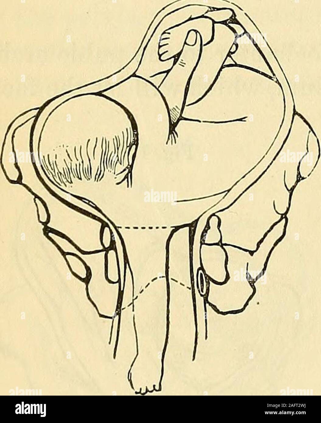 Obstetrics The Science And The Art 09explains The Operation The Left Hand Isemployed For Its Fingers Go Out Towardsthe Pelvic Extremity Of The Child Andits Palm In Easy Pronation Adaptsitself To