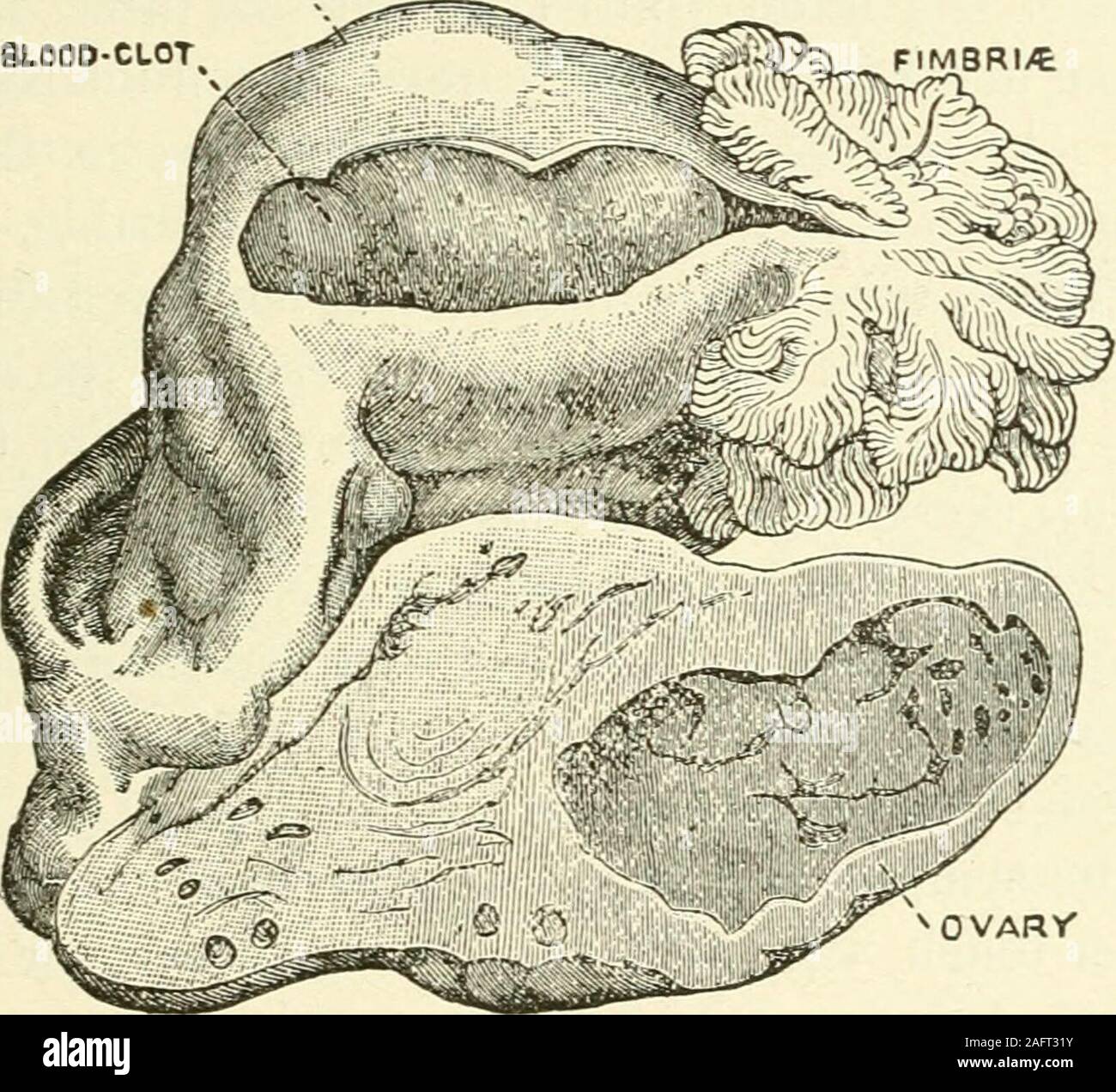 Oophoritis: Symptoms, Causes, and More