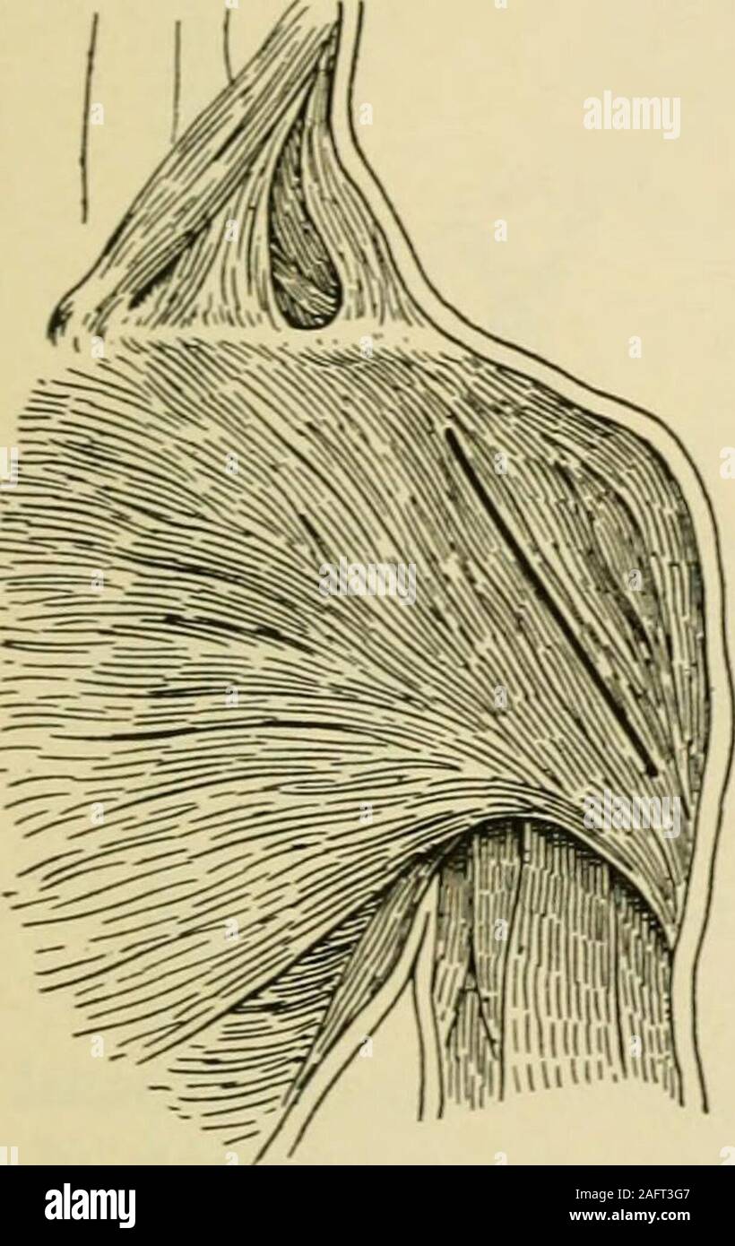 . Manual of operative surgery. towards the inser-tion of the deltoid (Fig. 1340). The incision divides the skin and subcutaneoustissues. Distinguish the anterior or internal (pectoro-deltoid groove) border ofthe deltoid. Incise the deltoid a little to the outside of, and parallel to its inter-nal margin, thus avoiding injury to the cephalic vein and a large branch of theacromio-thoracic artery. Retract the outer side of the wound (skin and del-toid), thus exposing the head of the humerus. Step 2.—Rotate the arms so as to make out the bicipital groove. Incise thejoint capsule throughout its who Stock Photo