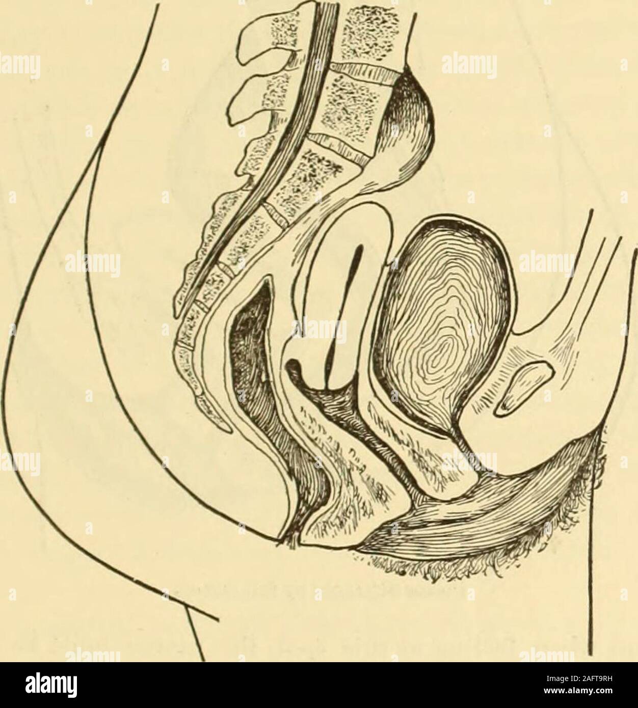 . Clinical gyncology, medical and surgical. Normal mobility of uterus (diagrammatic). DISPLACEMENTS OF THE UTERUS. 467 vanced is that some authors have not taken into account the feet that in itsphysiological condition the uterus is a movable organ subject to all thevariations of position which are dependent upon the different degrees offulness of the bladder and of the rectum and the movements of expirationand inspiration and of increased or diminished intra-abdominal pressure.The other reason why authors differ or have differed in their descriptionof the normal position of the uterus is that Stock Photo