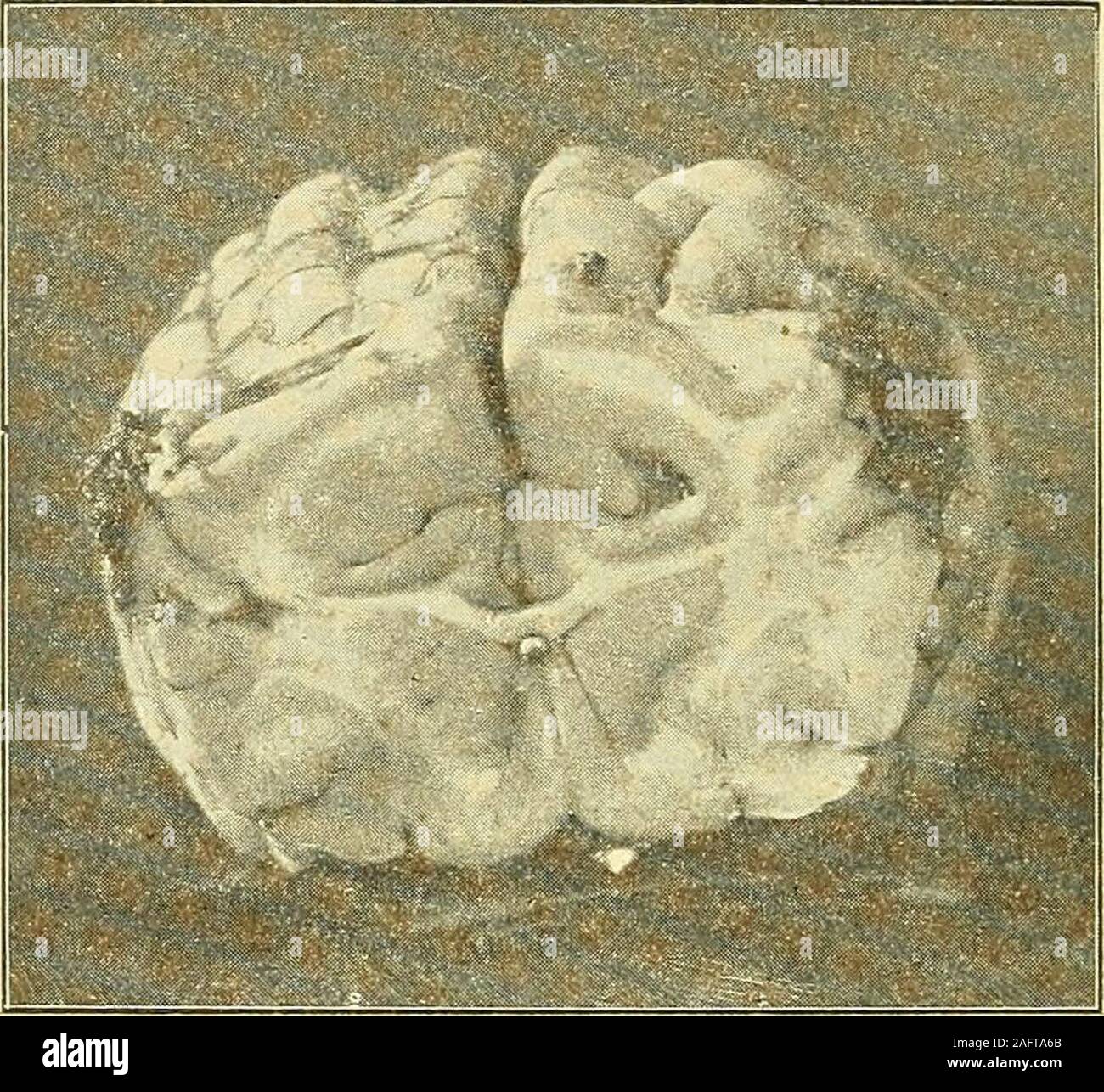 . Physiologische und klinische Untersuchungen über das Gehirn, gesammelte Abhandlungen. Fig. 66. Nasenlidreflex: Beiderseits überhaupt schwach, rechts aber theils ganzfehlend, theils noch schwächer bis zum 17. Tage. Später beiderseits gleich. Cornealreflex unverändert. Sensibilität der Zunge etc.: Verliert anfänglich oft Fleischstücke,sonst nichts nachweisbar. — 236 — Getödtet nach h^j^ Monaten; inzwischen eine 2. symmetrische Operation. Section: Häute normal. Eine etwa 23 mm lange und 10 mm breiteNarbe befindet sich lateral vom Gyrus sigmoides gerade den lateralen Randdesselben berührend, abe Stock Photo